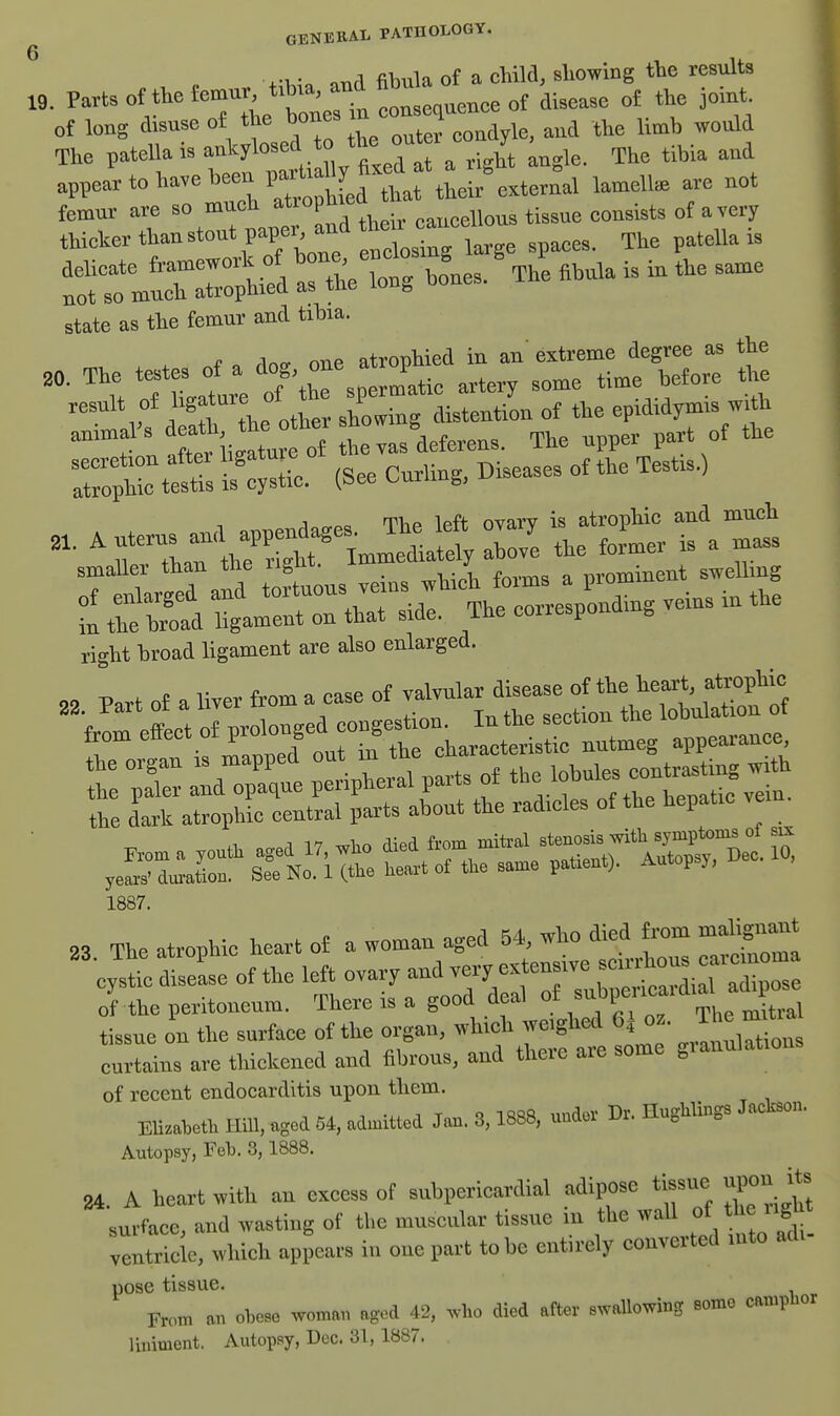 6 .•1 • nr^rl fibula of a child, sliowing tbe results 19. ^^^^om^t^r^nr^ ^^^^^^^ ^^^^^^ „j joint of loBg disuse oi the ^^^^^e oute. eoadyle, and the limb would The patella is an^losed to the out , ^.^.^ appear to have been pariiall fixe^^^^^ ^^^^^^ femur are so much ^'''P^'f J . ^^^.^llou, tissue consists of a thicker than stout paper and ^he patella is ^tarir:^^^ :t bo\es. .^.^ is in the same State as the femur and tihia. r 1 ^ nnP atrophied in an' extreme degree as the '^:7tl:e TZ\;Tllic artery some time before tlje result of I'S^ture 0 l ^j^^^^^j^^ of the epididymis with animal's „,=a,feens. The upper part of the Z^:;rs If (see CurUn,. Diseases of the Testis.) - ^ ^17^?!.:^^— :re rtJt if a ra:era:%o?tuous.einswhich^^^^^^^^ in the hroad ligament on that side. The eoriesponam^ right broad ligament are also enlarged. from etiect ot proi s & characteristic nutmeg appearance, t ;r LTa^t pti;er parts of lobules the dark atrophic central parts about the radicles of the hepatic vei 1887. 23 The atrophic heart of a woman aged 54, who died from malignant cystic rcLe of the left ovary and Tcry extensive ^«ntous cai— S the peritoneum. There is a good deal of -''P^J^-^^XS tissue on the surface of the organ, which weighed 6i o.. T^e m curtains are thickened and fibrous, and there are some gianulatiou of recent endocarditis upon them. EU^beti mu, aged 64, admitted Jan, 8,1888, uuder Br. HagUings Jactaon. Autopsy, rol>. 3,1888, 24. A heart with an excess of snbpericardial adipose tissue upon its surface, and wasting of tlie mu.cular tissue in the wall the ii^h ventricle, which appears in one part to bo entirely converted into ao. pose tissue. From an obese woman aged 42, who died after swallowing some campnor liniment. Autopsy, Dec. 31, 1887.