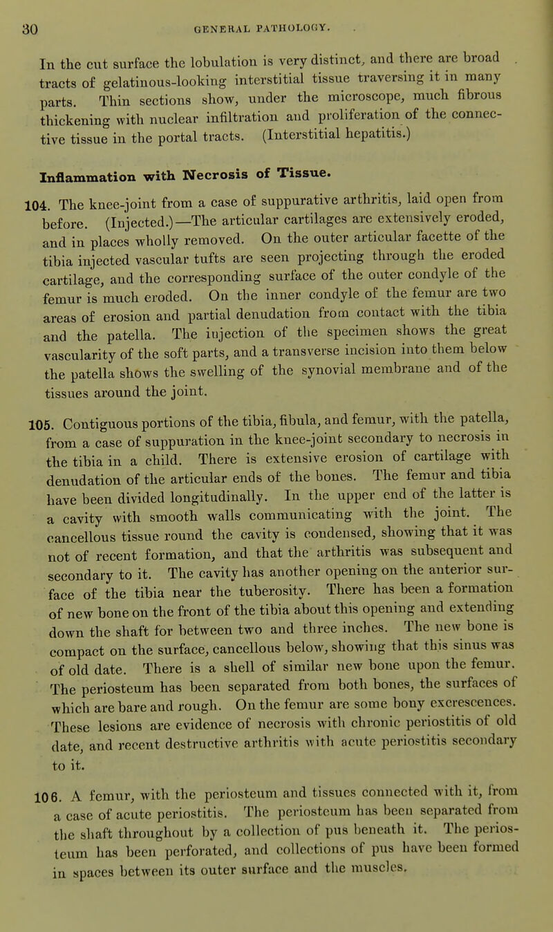 In the cut surface the lobulation is very distinct, and there are broad tracts of gelatinous-looking interstitial tissue traversing it in many parts. Thin sections sliow, under the microscope, mucli fibrous thickening with nuclear infiltration and proliferation of the connec- tive tissue in the portal tracts. (Interstitial hepatitis.) Inflammation with Necrosis of Tissue. 104. The knee-joint from a case of suppurative arthritis, laid open from before. (Injected.)—The articular cartilages are extensively eroded, and in places wholly removed. On the outer articular facette of the tibia injected vascular tufts are seen projecting through the eroded cartilage, and the corresponding surface of the outer condyle of the femur is much eroded. On the inner condyle of the femur are two areas of erosion and partial denudation from contact with the tibia and the patella. The injection of the specimen shows the great vascularity of the soft parts, and a transverse incision into them below the patella shows the swelling of the synovial membrane and of the tissues around the joint. 105. Contiguous portions of the tibia, fibula, and femur, with the patella, from a case of suppuration in the knee-joint secondary to necrosis in the tibia in a child. There is extensive erosion of cartilage with denudation of the articular ends of the bones. The femur and tibia have been divided longitudinally. In the upper end of the latter is a cavity with smooth walls communicating with the joint. The cancellous tissue round the cavity is condensed, showing that it was not of recent formation, and that the arthritis was subsequent and secondary to it. The cavity has another opening on the anterior sur- face of the tibia near the tuberosity. There has been a formation of new bone on the front of the tibia about this opening and extending down the shaft for between two and three inches. The new bone is compact on the surface, cancellous below, showing that this sinus was of old date. There is a shell of similar new bone upon the femur. The periosteum has been separated from both bones, the surfaces of which are bare and rough. On the femur are some bony excrescences. These lesions are evidence of necrosis with chronic periostitis of old date, and recent destructive arthritis with acute periostitis secondary to it. 106. A femur, with the periosteum and tissues connected with it, from a case of acute periostitis. The periosteum has been separated from the shaft throughout by a collection of pus beneath it. The perios- teum has been perforated, and collections of pus have been formed in spaces between its outer surface and the muscles.