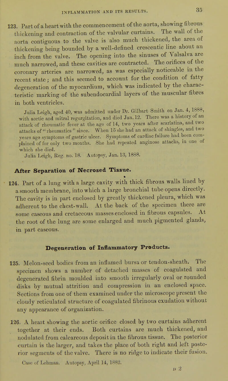 123. Part of a heart with the commencement of the aorta, showing fibrous thickening and contraction of the valvular curtains. The wall of the aorta contiguous to the valve is also much thickened, the area of thickening being bounded by a well-defined crescentic line about an inch from the valve. The opening into the sinuses of Valsalva are much narrowed, and these cavities are contracted. The orifices of the coronary arteries are narrowed, as was especially noticeable m the recent state; and this seemed to account for the condition of fatty degeneration of the myocardium, which was indicated by the charac- teristic marking of the subendocardial layers of the muscular fibres in both ventricles. Julia Leigli, aged 40, was admitted under Dr. Gilbart Smith on Jan. 4,1888, with aortic and mitral regurgitation, and died Jan. 12. There was a history of an attack of rheumatic fever at the age of 14, two years after scarlatina, and two attacks of  rheumatics  since. When 15 she had an attack of shingles, and two years ago symptoms of gastric ulcer. Symptoms of cardiac failure had been com- plained'of for only two mouths. She had repeated angmose attacks, in one of which she died. Julia Leigh, Reg. no. 18. Autopsy, Jan, 13, 1888. After Separation of Necrosed Tissue. 124. Part of a lung with a large cavity with thick fibrous walls lined by a smooth membrane, into which a large bronchial tube opens directly. The cavity is in part enclosed by greatly thickened pleura, which was adherent to the chest-wall. At the back of the specimen there are some caseous and cretaceous masses enclosed in fibrous capsules. At the root of the lung are some enlarged and much pigmented glands, in part caseous. Degeneration of Inflammatory Products. 125. Melon-seed bodies from an inflamed bursa or tendon-sheath. The specimen shows a number of detached masses of coagulated and degenerated fibrin moulded into smooth irregularly oval or rounded disks by mutual attrition and compression in an enclosed space. Sections from one of them examined under the microscope present the cloudy reticulated structure of coagulated fibrinous exudation without any appearance of organization. 126. A heart showing the aortic orifice closed by two curtains adherent together at their ends. Both curtains are much thickened, and nodulated from calcareous deposit in the fibrous tissue. The posterior curtain is the larger, and takes the place of both right and left poste- rior segments of the valve. There is no ridge to indicate their fusion. Case of Lehman. Autopsv. April 14, 188:i. j» 2