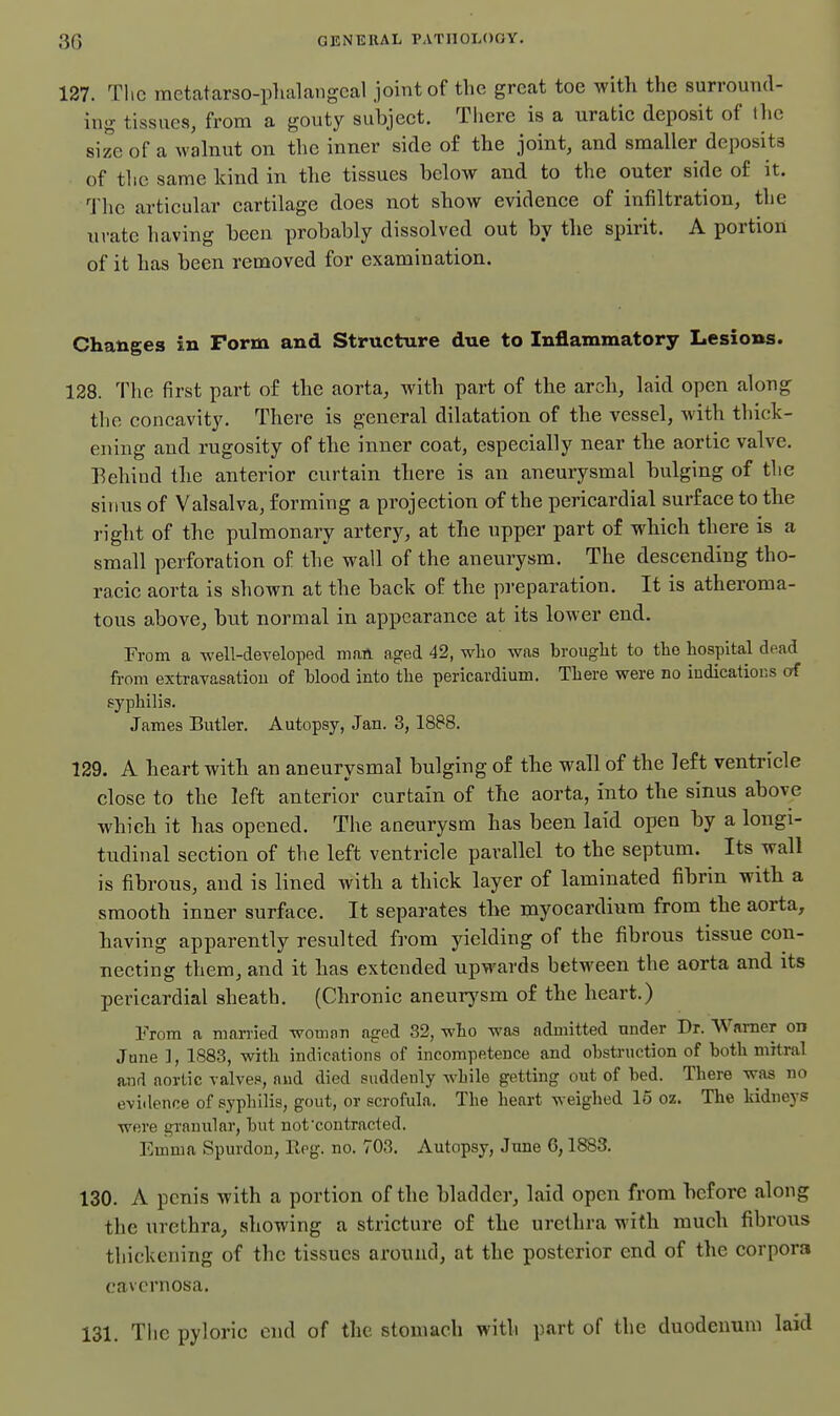 GJiNEKAL PATlIOLOtlY. 127. The metatarso-phalangcal joint of the great toe with the surround- ing tissues, from a gouty subject. There is a uratic deposit of the size of a walnut on the inner side of the joint, and smaller deposits of the same kind in the tissues below and to the outer side of it. The articular cartilage does not show evidence of infiltration, the urate having been probably dissolved out by the spirit. A portion of it has been removed for examination. Changes in Form and Structure due to Inflammatory Lesions. 128. The first part of the aorta, with part of the arch, laid open along the concavity. There is general dilatation of the vessel, with thick- ening and rugosity of the inner coat, especially near the aortic valve. Behind the anterior curtain there is an aneurysmal bulging of the sinus of Valsalva, forming a projection of the pericardial surface to the right of the pulmonary artery, at the upper part of which there is a small perforation of the wall of the aneurysm. The descending tho- racic aorta is shown at the back of the preparation. It is atheroma- tous above, but normal in appearance at its lower end. From a well-developed man aged 42, wlio was brouglit to the hospital dead from extravasation of blood into tlie pericardium. Tbere were no indications of syphilis. James Butler. Autopsy, Jan. 3, 1888. 129. A heart with an aneurysmal bulging of the wall of the left ventricle close to the left anterior curtain of the aorta, into the sinus above which it has opened. The aneurysm has been laid open by a longi- tudinal section of the left ventricle parallel to the septum. Its wall is fibrous, and is lined with a thick layer of laminated fibrin with a smooth inner surface. It separates the myocardium from the aorta, having apparently resulted from yielding of the fibrous tissue con- necting them, and it has extended upwards between the aorta and its pericardial sheath. (Chronic aneurj^sm of the heart.) From a married woman aged 32, who was admitted nnder Dr. Warner on June 1, 1883, with indications of incompetence and obstruction of both mitral and aortic valves, and died suddenly while getting out of bed. There was no evidence of syphilis, gout, or scrofula. The heart weighed 15 oz. The kidneys were granular, but not contracted. Emma Spurdon, Rog. no. 703. Autopsy, June 6,1883. 130. A penis with a portion of the bladder, laid open from before along the urethra, showing a stricture of the urethra with much fibrous thickening of the tissues around, at the posterior end of the corpora cavernosa. 131. Tiie pyloric end of the stomach with part of the duodenum laid