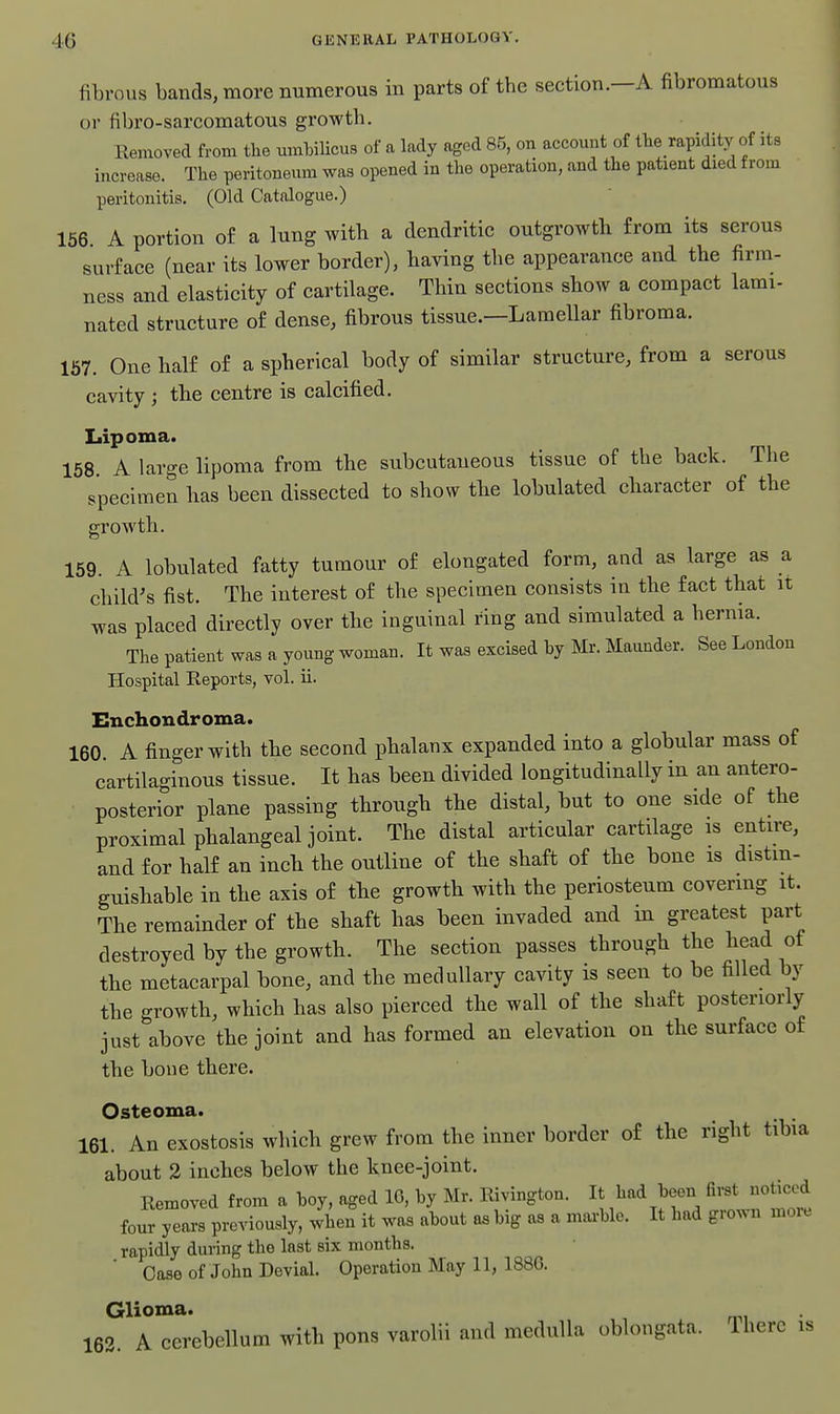 40 GKNliKAL, PATUOLOGV. fibrous bands, more numerous in parts of the section.—A fibromatous or fibro-sarcomatous growth. Removed from the umbilicus of a lady aged 85, on account of the rapidity of its increase. The peritoneum was opened in the operation, and the patient died from peritonitis. (Old Catalogue.) 156 A portion of a lung with a dendritic outgrowth from its serous surface (near its lower border), having the appearance and the firm- ness and elasticity of cartilage. Thin sections show a compact lami- nated structure of dense, fibrous tissue.—Lamellar fibroma. 167. One half of a spherical body of similar structure, from a serous cavity ; the centre is calcified. Lipoma. 158. A large lipoma from the subcutaneous tissue of the back. The specimen has been dissected to show the lobulated character of the growth. 159. A lobulated fatty tumour of elongated form, aad as large as a child's fist. The interest of the specimen consists in the fact that it was placed directly over the inguinal ring and simulated a hernia. The patient was a young woman. It was excised hy Mr. Maunder. See London Hospital Reports, vol. ii. Enchondroma. 160 A finger with the second phalanx expanded into a globular mass of cartilaginous tissue. It has been divided longitudinally in an antero- posterior plane passing through the distal, but to one side of the proximal phalangeal joint. The distal articular cartilage is entire, and for half an inch the outline of the shaft of the bone is distin- guishable in the axis of the growth with the periosteum covering it. The remainder of the shaft has been invaded and in greatest part destroyed by the growth. The section passes through the head of the metacarpal bone, and the medullary cavity is seen to be filled by the growth, which has also pierced the wall of the shaft posteriorly just above the joint and has formed an elevation on the surface of the bone there. Osteoma. 161. An exostosis which grew from the inner border of the right tibia about 2 inches below the knee-joint. Removed from a boy, aged IG, by Mr. Rivington. It had been first noticed four years previously, when it was about as big as a mai-ble. It had grown more rapidly during the last six months. Case of John Devial. Operation May 11, 188G. Glioma. 163. A cerebellum with pons varolii and medulla oblongata. There is