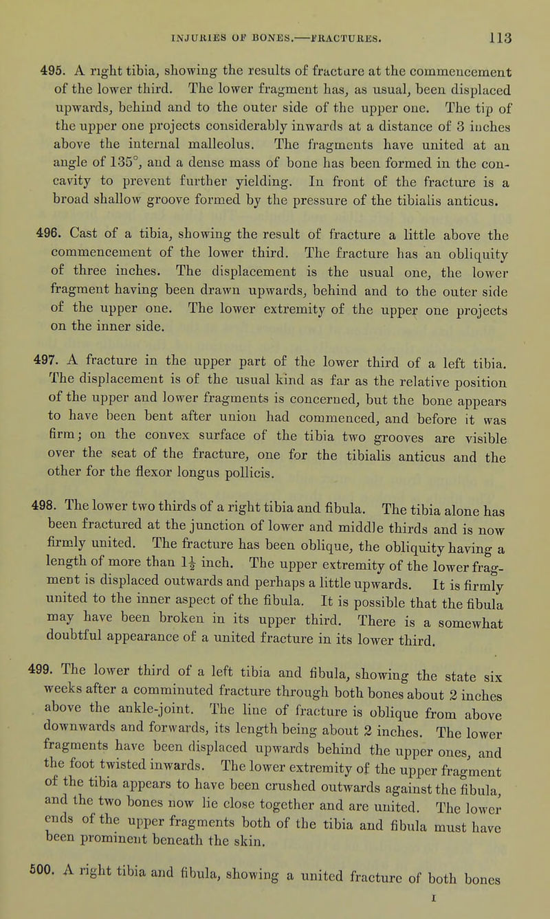 495. A right tibia, showing the results of fracture at the commencement of the lower third. The lower fragment has, as usual, been displaced upwards, behind and to the outer side of the upper one. The tip of the upper one projects considerably inwards at a distance of 3 inches above the internal malleolus. The fragments have united at an angle of 135°, and a dense mass of bone has been formed in the con- cavity to prevent further yielding. In front of the fracture is a broad shallow groove formed by the pressure of the tibialis anticus. 496. Cast of a tibia, showing the result of fracture a little above the commencement of the lower third. The fracture has an obliquity of three inches. The displacement is the usual one, the lower fragment having been drawn upwards, behind and to the outer side of the upper one. The lower extremity of the upper one projects on the inner side. 497. A fracture in the upper part of the lower third of a left tibia. The displacement is of the usual kind as far as the relative position of the upper and lower fragments is concerned, but the bone appears to have been bent after union had commenced, and before it was firm; on the convex surface of the tibia two grooves are visible over the seat of the fracture, one for the tibialis anticus and the other for the flexor longus pollicis. 498. The lower two thirds of a right tibia and fibula. The tibia alone has been fractured at the junction of lower and middle thirds and is now firmly united. The fracture has been oblique, the obliquity having a length of more than 1^ inch. The upper extremity of the lower frag- ment is displaced outwards and perhaps a little upwards. It is firmly united to the inner aspect of the fibula. It is possible that the fibula may have been broken in its upper third. There is a somewhat doubtful appearance of a united fracture in its lower third. 499. The lower third of a left tibia and fibula, showing the state six weeks after a comminuted fracture through both bones about 2 inches above the ankle-joint. The line of fracture is oblique from above downwards and forwards, its length being about 2 inches. The lower fragments have been displaced upwards behind the upper ones, and the foot twisted inwards. The lower extremity of the upper fragment of the tibia appears to have been crushed outwards against the fibula, and the two bones now lie close together and are united. The lower ends of the upper fragments both of the tibia and fibula must have been prominent beneath the skin. 500. A right tibia and fibula, showing a united fracture of both bones