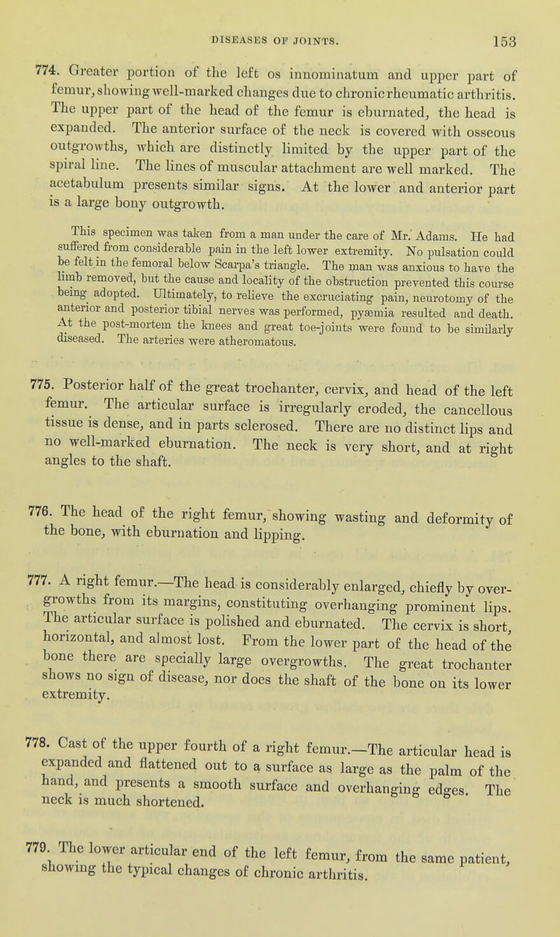 774. Greater portion of the left os innominatum and upper part of femur, showing well-marked changes due to chronic rheumatic arthritis. The upper part of the head of the femur is eburnated, the head is expanded. The anterior surface of the neck is covered with osseous outgrowths, which are distinctly limited by the upper part of the spiral line. The lines of muscular attachment are well marked. The acetabulum presents similar signs. At the lower and anterior part is a large bony outgrowth. This specimen was taken from a man under the care of Mr,' Adams. He had suffered from considerable pain in the left lower extremity. No pulsation could be felt.in the femoral below Scarpa's triangle. The man was anxious to have the hrnb removed, but the cause and locality of the obstruction prevented this course bemg adopted. Ultimately, to reHeve the excruciating pain, neurotomy of the antenor and posterior tibial nerves was performed, pyemia resulted and death. At the post-mortem the knees and great toe-joints were fouud to be simHarly diseased. The arteries were atheromatous. 775. Posterior half of the great trochanter, cervix, and head of the left femur. The articular surface is irregularly eroded, the cancellous tissue is dense, and in parts sclerosed. There are no distinct lips and no well-marked eburnation. The neck is very short, and at right angles to the shaft. 776. The head of the right femur, showing wasting and deformity of the bone, with eburnation and lipping. 777. A right femur.—The head is considerably enlarged, chiefly by over- growths from its margins, constituting overhanging prominent lips. The articular surface is polished and eburnated. The cervix is short horizontal, and almost lost. From the lower part of the head of the bone there are specially large overgrowths. The great trochanter shows no sign of disease, nor does the shaft of the bone on its lower extremity. 778. Cast of the upper fourth of a right femur.-The articular head is expanded and flattened out to a surface as large as the palm of the hand, and presents a smooth surface and overhanging edges. The neck is much shortened. 779 The lower articular end of the left femur, from the same patient, showing the typical changes of chronic arthritis.