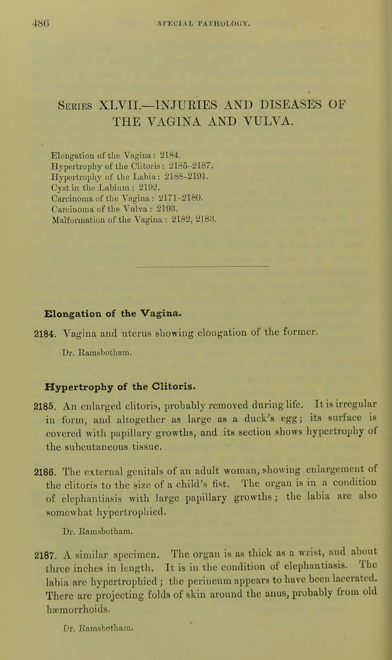 Series XLVIL—INJURIES AND DISEASES OF THE VAGINA AND VULVA. Elongation of the Vagina: 2184. Hvpei-tropliy of the Clltons : 2185-2187. Hypertrophy of the Labia: 2188-2191. Cyst in the Labium : 2192. Carcinoma of the Vagina : 2171-2180. Carcinoma of the Vulva : 2193. Malformation of the Vagina : 2182, 218.S. Elongation of the Vagina. 2184. Vagina and uterus showing elongation of the former. Dr. Ramsbotham. Hypertrophy of the Clitoris. 2185. An enlarged clitoris, probably removed during life. It is irregular in form, and altogether as large as a duck's egg; its surface is covered with papillary growths, and its section shows hypertrophy of the subcutaneous tissue. 2186. The external genitals of an adult woman, showing enlargement of the clitoris to the size of a child's fist. The organ is in a condition of elephantiasis with large painllary growths; the labia are also somewhat hypertrophied. Dr. Ramsbotham. 2187. A similar specimen. The organ is as thick as a wrist, and about three inches in length. It is in the condition of elephantiasis. The labia are hypertrophied; the perineum appears to have been lacerated. There are projecting folds of skin around the anus, probably from old hseraorrhoids. Dr. Ramsbotham.