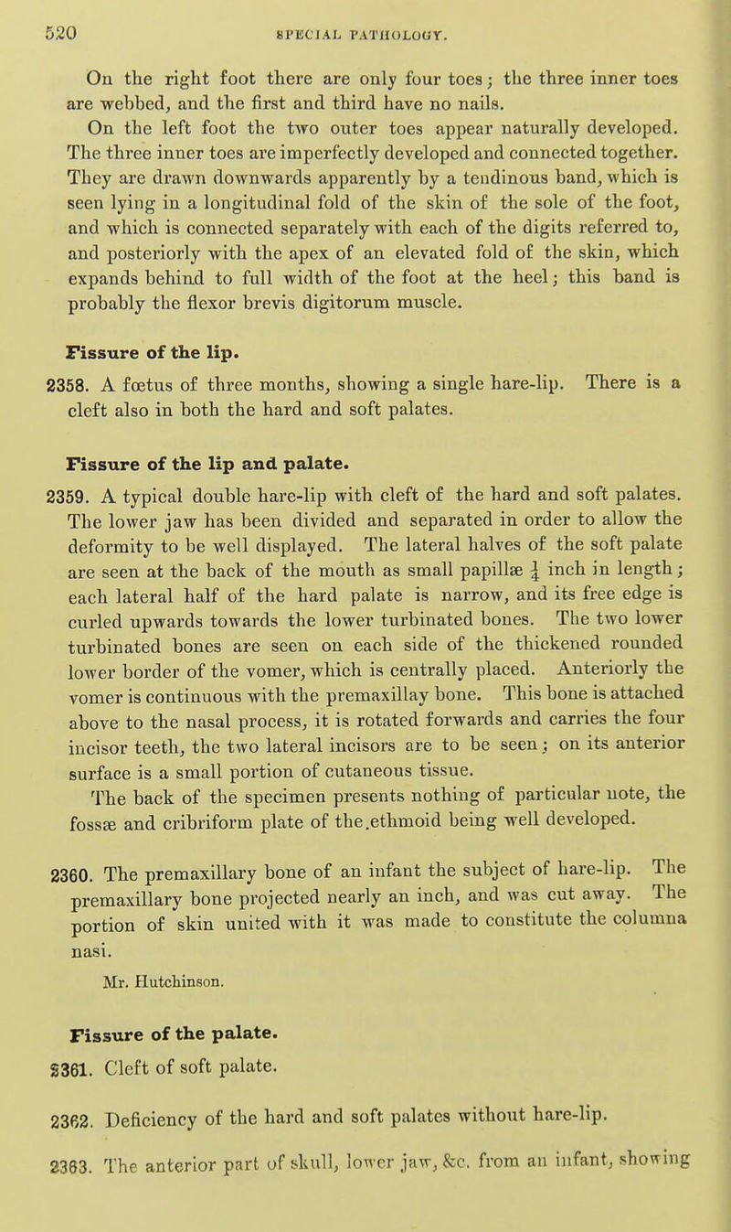 On the right foot there are only four toes; the three inner toes are webbed, and the first and third have no nails. On the left foot the two outer toes appear naturally developed. The three inner toes are imperfectly developed and connected together. They are drawn downwards apparently by a tendinous band, which is seen lying in a longitudinal fold of the skin of the sole of the foot, and which is connected separately with each of the digits referred to, and posteriorly with the apex of an elevated fold of the skin, which expands behind to full width of the foot at the heel; this band is probably the flexor brevis digitorum muscle. Fissure of the lip. 2358. A foetus of three months, showing a single hare-lip. There is a cleft also in both the hard and soft palates. Fissure of the lip and palate. 2359. A typical double hare-lip with cleft of the hard and soft palates. The lower jaw has been divided and separated in order to allow the deformity to be well displayed. The lateral halves of the soft palate are seen at the back of the mouth as small papillae I inch in length; each lateral half of the hard palate is narrow, and its free edge is curled upwards towards the lower turbinated bones. The two lower turbinated bones are seen on each side of the thickened rounded lower border of the vomer, which is centrally placed. Anteriorly the vomer is continuous with the premaxillay bone. This bone is attached above to the nasal process, it is rotated forwards and carries the four incisor teeth, the two lateral incisors are to be seen; on its anterior surface is a small portion of cutaneous tissue. The back of the specimen presents nothing of particular note, the foss£e and cribriform plate of the.ethmoid being well developed. 2360. The premaxillary bone of an infant the subject of hare-lip. The premaxillary bone projected nearly an inch, and was cut away. The portion of skin united with it was made to constitute the columna nasi. Mr. Plutcliinson. Fissure of the palate. S361. Cleft of soft palate. 2362. Deficiency of the hard and soft palates without hare-lip. 2383. The anterior part of skull, lower jaw, &c. from an infant^ .showing