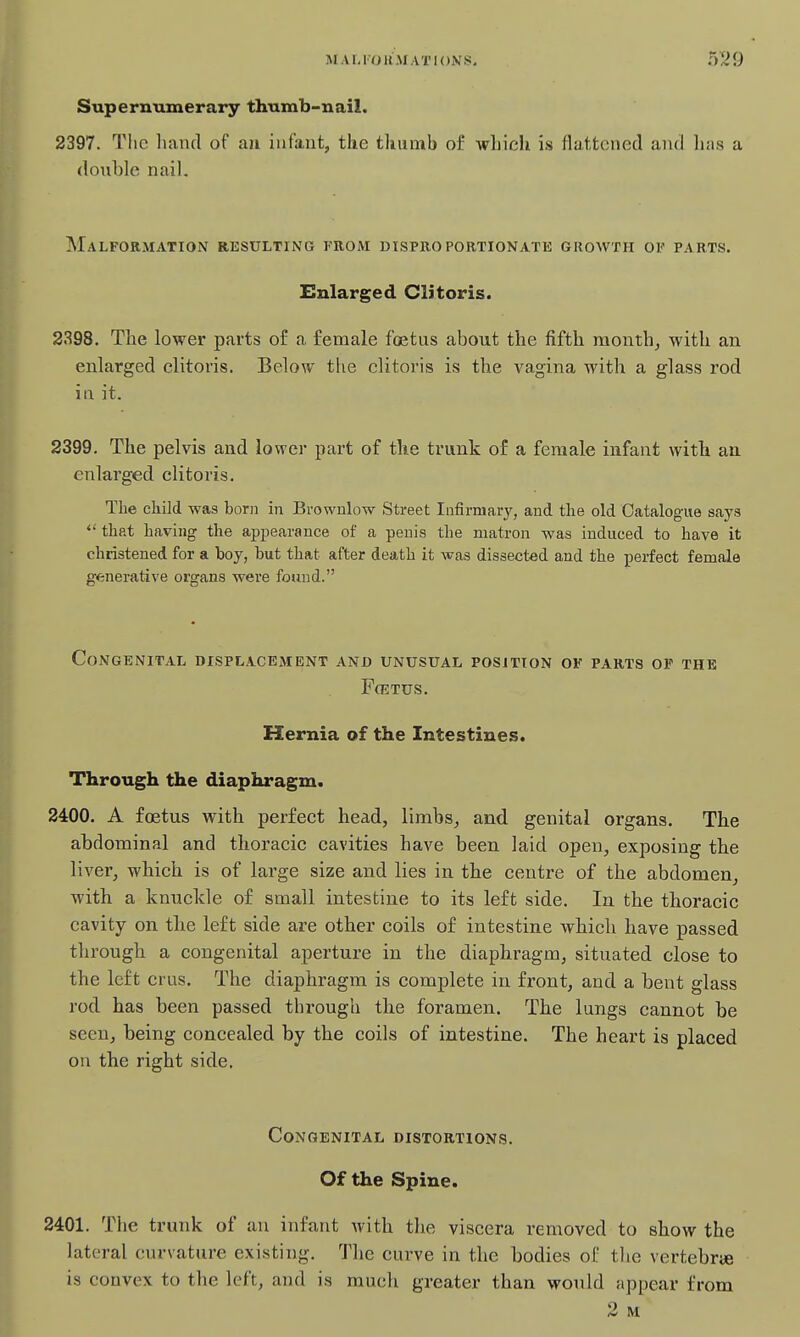 Superntimeraiy thnmb-nail. 2397. Tlic hand of aa infant, the tliiimb of Adiich is flattened and has a double nail. Malformation resulting from disproportionate growth of parts. Enlarged Clitoris. 2398. The lower parts of a female foetus about the fifth monthj with an enlarged clitoris. Below the clitoi-is is the vagina with a glass rod in it. 2399. The pelvis and lower part of the trunk of a female infant vvitli aa enlarged clitoris. The child was born in Brownlow Street Iiifirmarj^, and the old Catalogue says  that having the appearance of a penis the matron was induced to have it christened for a boy, but that after death it was dissected and the perfect female generative organs were found. Congenital displacement and unusual position of parts of the Fcetus. Hernia of the Intestines. Through the diaphragm. 2400. A foetus with perfect head, limbs^ and genital organs. The abdominal and thoracic cavities have been laid open, exposing the liver, which is of large size and lies in the centre of the abdomen, with a knuckle of small intestine to its left side. In the thoracic cavity on tlie left side are other coils of intestine which have passed through a congenital aperture in the diaphragm, situated close to the left crus. The diaphragm is complete in front, and a bent glass rod has been passed through tlie foramen. The lungs cannot be seen, being concealed by the coils of intestine. The heart is placed on the right side. Congenital distortions. Of the Spine. 2401. The trunk of an infant with the viscera removed to show the lateral curvature existing. The curve in the bodies of the vertebrae is convex to the left, and is much greater than would appear from 2 M
