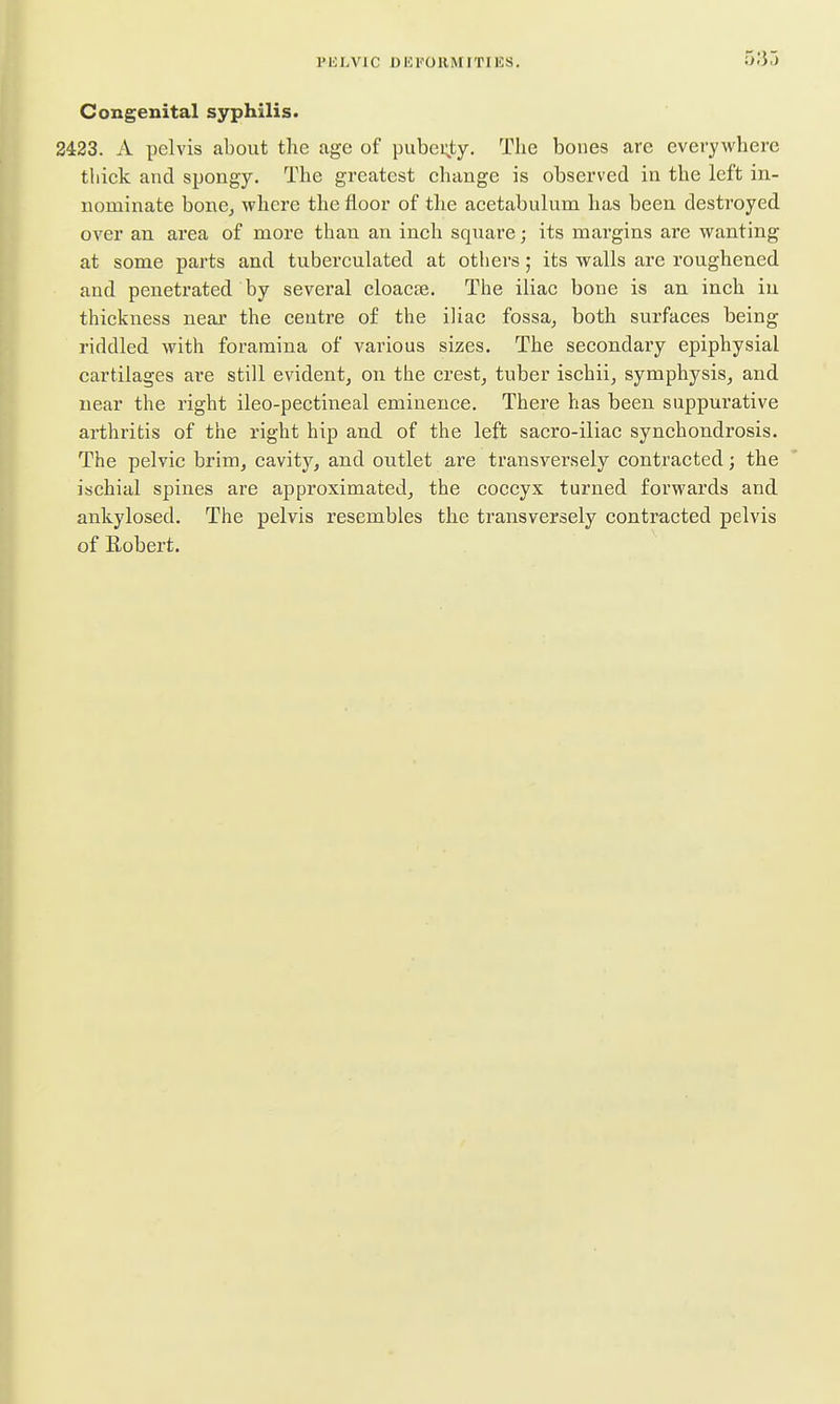 Congenital syphilis. 2423. A pelvis about the age of pubei;ty. The bones are everywhere thick and spongy. The greatest change is observed in the left in- nominate bonCj where the floor of the acetabulum has been destroyed over an area of more than an inch square; its margins are wanting at some parts and tuberculated at others; its walls are roughened and penetrated by several cloacse. The iliac bone is an inch in thickness near the centre of the iliac fossa, both surfaces being riddled with foramina of various sizes. The secondary epiphysial cartilages are still evident, on the crest, tuber ischii, symphysis, and near the right ileo-pectineal eminence. There has been suppurative arthritis of the right hip and of the left sacro-iliac synchondrosis. The pelvic brim, cavity, and outlet are transversely contracted; the ischial spines are approximated, the coccyx turned forwards and ankylosed. The pelvis resembles the transversely contracted pelvis of Robert.