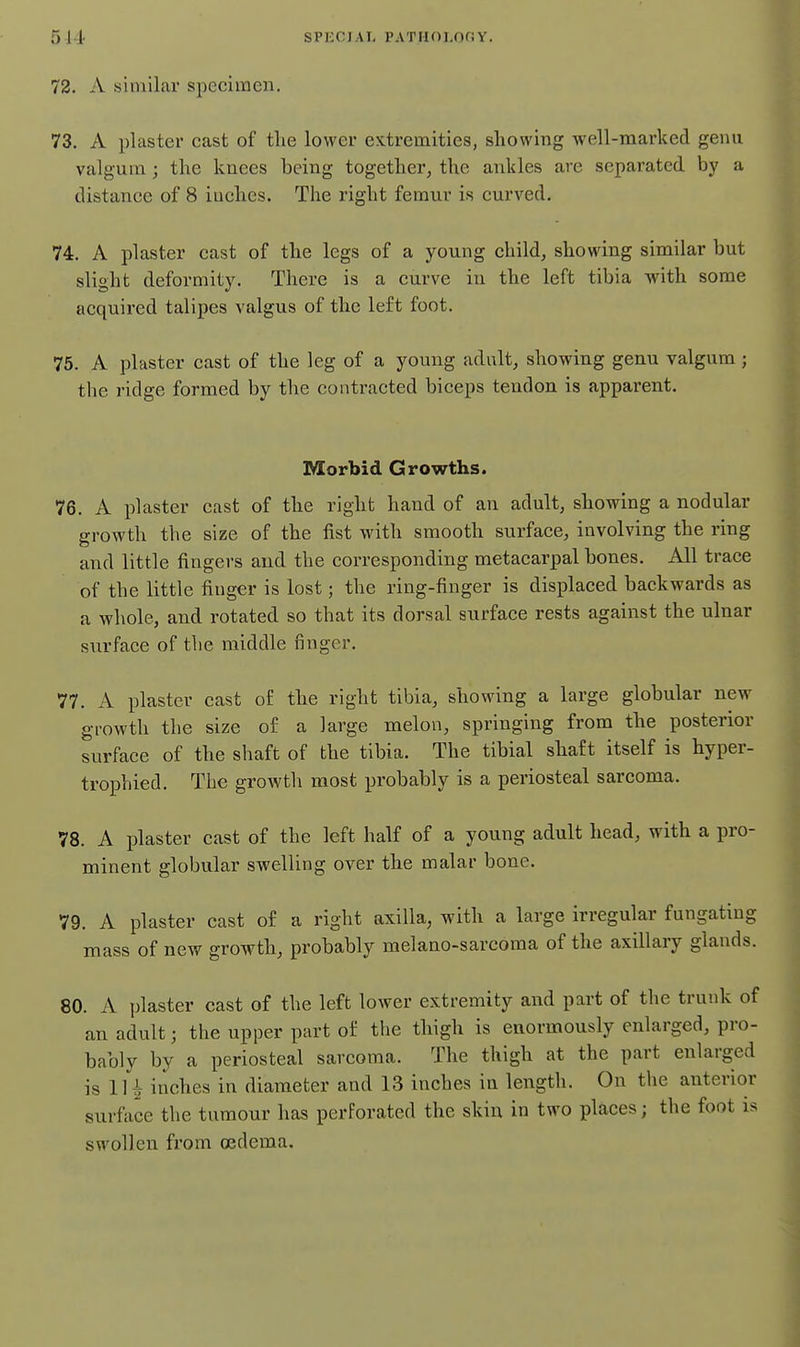 511- SPKCIAI, PATIlOl.OfiV 72. A similar specimen. 73. A plaster cast of the lower extremities, showing well-marked genu valgum ; the knees being together, the ankles are separated by a distance of 8 iuches. The right femur is curved. 74. A plaster cast of the legs of a young child, showing similar but slight deformity. There is a curve in the left tibia with some acquired talipes valgus of the left foot. 75. A plaster cast of the leg of a young adult, showing genu valgum ; the ridge formed by the contracted biceps tendon is apparent. Morbid Growths. 76. A plaster cast of the right hand of an adult, showing a nodular growth the size of the fist with smooth surface, involving the ring and little fingers and the corresponding metacarpal bones. All trace of the little finger is lost; the ring-finger is displaced backwards as a whole, and rotated so that its dorsal surface rests against the ulnar surface of the middle finger. 77. A plaster cast of the right tibia, showing a large globular new growth the size of a large melon, springing from the posterior surface of the shaft of the tibia. The tibial shaft itself is hyper- trophied. The growth most probably is a periosteal sarcoma. 78. A plaster cast of the left half of a young adult head, with a pro- minent globular swelling over the malar bone. 79. A plaster cast of a right axilla, with a large irregular fungating mass of new growth, probably melano-sarcoma of the axillary glands. 80. A plaster cast of the left lower extremity and part of the trunk of an adult; the upper part of the thigh is enormously enlarged, pro- bably by a periosteal sarcoma. The thigh at the part enlarged is Hi inches in diameter and 13 inches ia length. On the anterior surface the tumour has perforated the skin in two places; the foot is swollen from oedema.