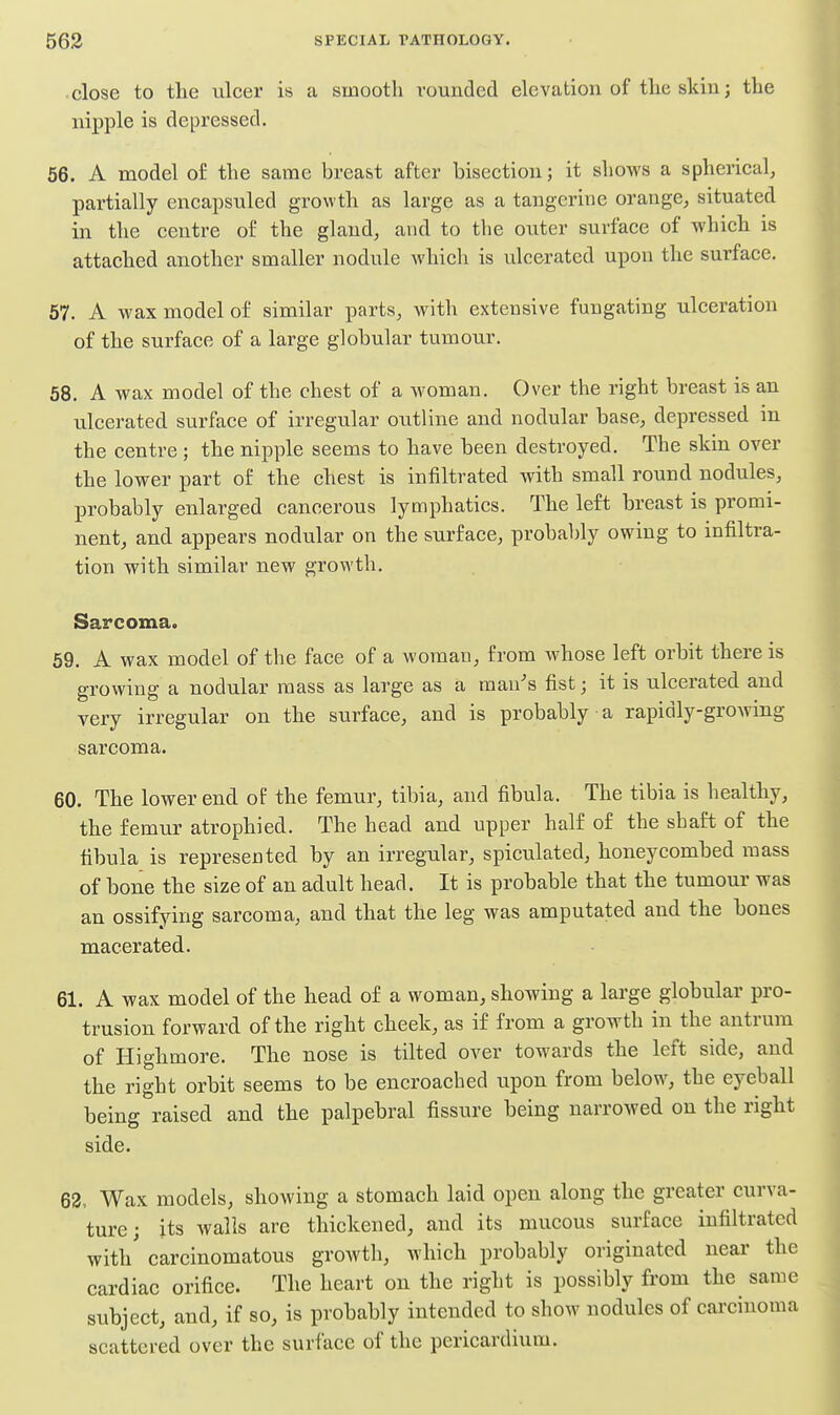 • close to the ulcer is a smooth rounded elevation of the skin; the nipple is depressed. 56. A model of the same breast after bisection; it shows a spherical, partially encapsuled growth as large as a tangerine orange, situated in the centre of the gland, and to tlie outer surface of which is attached another smaller nodule which is ulcerated upon the surface. 57. A wax model of similar parts, with extensive fungating ulceration of the surface of a large globular tumour. 58. A wax model of the chest of a woman. Over the right breast is an ulcerated surface of irregular outline and nodular base, depressed in the centre ; the nipple seems to have been destroyed. The skin over the lower part of the chest is infiltrated with small round nodules, probably enlarged cancerous lymphatics. The left breast is promi- nent, and appears nodular on the surface, probably owing to mfiltra- tion with similar new growth. Sarcoma. 59. A wax model of the face of a woman, from whose left orbit there is growing a nodular mass as large as a man's fist; it is ulcerated and very irregular on the surface, and is probably a rapidly-growing sarcoma. 60. The lower end of the femur, tibia, and fibula. The tibia is healthy, the femur atrophied. The head and upper half of the sbaft of the fibula is represented by an irregular, spiculated, honeycombed mass of bone the size of an adult head. It is probable that the tumour was an ossifying sarcoma, and that the leg was amputated and the bones macerated. 61. A wax model of the head of a woman, showing a large globular pro- trusion forward of the right cheek, as if from a growth in the antrum of Highmore. The nose is tilted over towards the left side, and the right orbit seems to be encroached upon from below, the eyeball being raised and the palpebral fissure being narrowed on the right side. 62. Wax models, showing a stomach laid open along the greater curva- ture; its walls are thickened, and its mucous surface infiltrated with' carcinomatous growth, which probably originated near the cardiac orifice. The heart on the right is possibly from the same subject, and, if so, is probably intended to show nodules of carcinoma scattered over the surface of the pericardium.