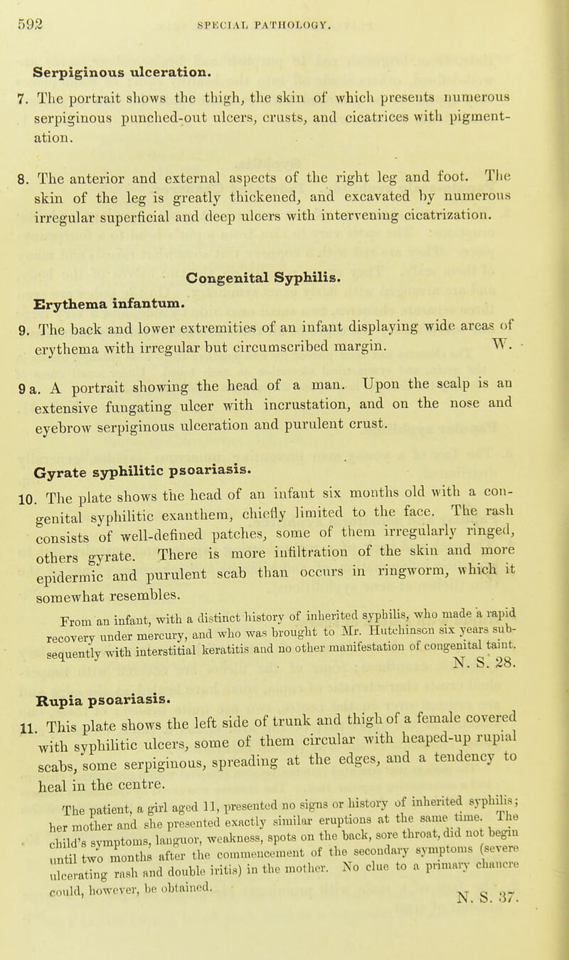 Serpiginous ulceration. 7. The portrait shows the thigh, tlie skin of which presents numerous serpiginous punched-oiit ulcers, crusts, and cicatrices with pigment- ation. 8. The anterior and external aspects of the I'ight leg and foot. Tlie skin of the leg is greatly thickened, and excavated by numerous irregular superficial and deep ulcers with intervening cicatrization. Congenital Syphilis. Erythema infantum. 9. The back and lower extremities of an infant displaying wide areas of erythema with irregular but circumscribed margin. W. • 9 a. A portrait showing the head of a man. Upon the scalp is an extensive fungating ulcer with incrustation, and on the nose and eyebrow serpiginous ulceration and purulent crust. Gyrate syphilitic psoariasis. 10. The plate shows the head of an infant six months old with a con- genital syphilitic exanthera, chiefly limited to the face. The rash consists of well-defined patches, some of them irregularly ringed, others gyrate. There is more infiltration of the skin and more epidermic and purulent scab than occurs in ringworm, which it somewhat resembles. From an infant, with a distinct history of inherited syphilis, who made a rapid recovery under mercury, and who was brought to Mr. Hutchinson six years sub- sequently Avith interstitial keratitis and no other manifestation of congenital taint. N. S. 28. Rupia psoariasis. 11 This plate shows the left side of trunk and thigh of a female covered with syphilitic ulcers, some of them circular with heaped-up rupial scabs, some serpiginous, spreading at the edges, and a tendency to heal in the centre. The patient, a girl aged 11, presented no signs or history of inherited syphilis; her mother and she presented exactly similar eruptions at the same tune The ch Id's symptoms, languor, weakness, spots on the back, sore throat, did no began mtn two months after the conamencement of the secondary symptoms severe ukerating rash and double iritis) in the motlior. No clue to a primary chancre could, however, be obtained. ^ ^