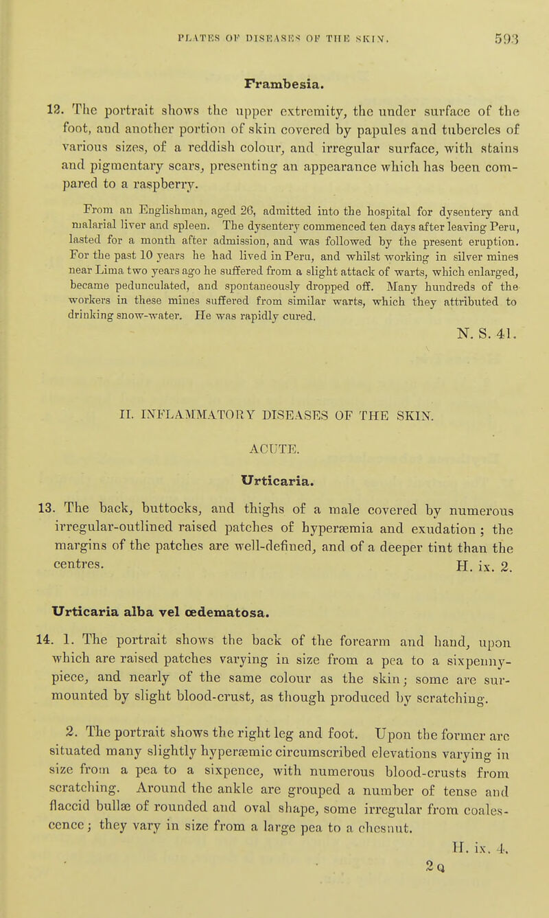 Frambesia. 13. The portrait shows the upper extremity, the under surface of the foot, aud another portion of skin covered by papules and tubercles of various sizes, of a reddish colour, and irregular surface, with stains and pigmentary scars^ presenting an appearance which has been com- pared to a raspberry. From an Englishman, aged 26, admitted into the hospital for dysentery and malarial liver and spleen. The dysentery commenced ten days after leaving Peru, lasted for a month after admission, and was followed by the present eruption. For the past 10 years he had lived in Peru, and whilst working in silver mines near Lima tvro years ago he sxiffered from a slight attack of warts, which enlarged, became pedunculated, and spontaneously dropped off. Many hundreds of the workers in these mines suffered from similar warts, which they attributed to drinking snow-water. He was rapidly cured. N. S. 41. II. INFLAMMATORY DISEASES OF THE SKIN. ACUTE. Urticaria. 13. The back, buttocks, and thighs of a male covered by numerous irregular-outlined raised patches of hyperemia and exudation ; the margins of the patches are well-defined, and of a deeper tint than the centres. H. ix. 2. Urticaria alba vel oedematosa. 14. 1. The portrait shows the back of tlie forearm and hand, upon Avhich are raised patches varying in size from a pea to a sixpenny- piece, and nearly of the same colour as the skin; some are sur- mounted by slight blood-crust, as though produced by scratching. 2. The portrait shows the right leg and foot. Upon the former arc situated many slightly hypersemic circumscribed elevations varying in size from a pea to a sixpence, with numerous blood-crusts from scratching. Around the ankle are grouped a number of tense and flaccid bullae of rounded and oval shape, some irregular from coales- cence; they vary in size from a large pea to a ches-aut. H. ix. 4. 2q