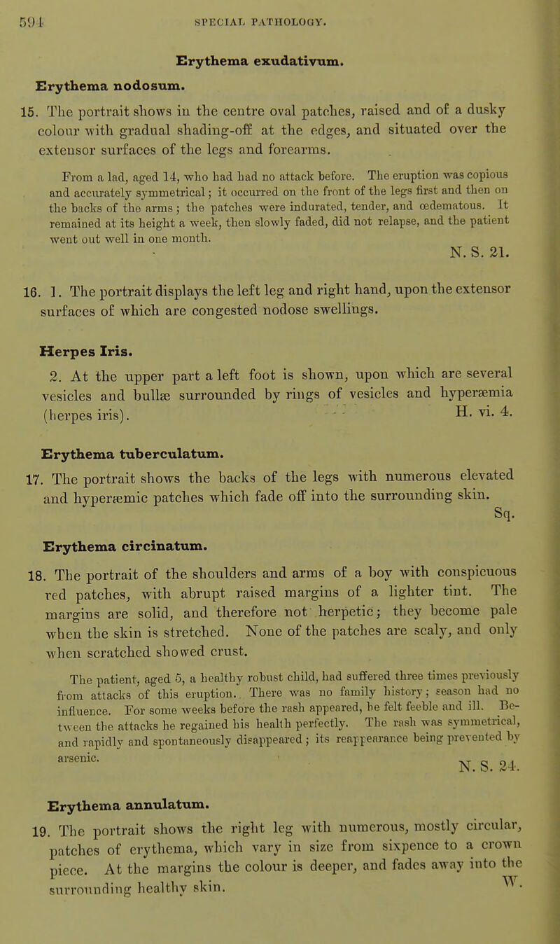 Erythema exudatiyum. Erythema nodosum. 15. The portrait shows iu the ceutre oval patches, raised and o£ a dusky colour with gradual shading-ofE at the edges, and situated over the extensor surfaces of the legs and forearms. From a lad, aged 14, who had had no attack before. The eruption was copious and accurately symmetrical; it occurred on the front of the legs first and then on the hacks of the arms ; the patches were indurated, tender, and oedematous. It remained at its height a week, then slowly faded, did not relapse, and the patient went out well in one month. N. S. 21. 16. ]. The portrait displays the left leg and right hand, upon the extensor surfaces of which are congested nodose swellings. Herpes Iris. 2. At the upper part a left foot is shown, upon which are several vesicles and buUse surrounded by rings of vesicles and hyperaemia (herpes iris). H. vi. 4. Erythema tuberculatum. 17. The portrait shows the backs of the legs with numerous elevated and hyperjemic patches which fade off into the surrounding skin. Sq. Erythema circinatum. 18. The portrait of the shoulders and arms of a boy with conspicuous red patches, with abrupt raised margins of a lighter tint. The margins are solid, and therefore not herpetic; they become pale when the skin is stretched. None of the patches are scaly, and only when scratched showed crust. The patient, aged 5, a healthy robust child, had suffered three times previously from attacks of this eruption. There was no family history; season had no influence. For some weeks before the rash appeared, he felt feeble and ill. Be- tween the attacks he regained his health perfectly. The rash was symmetrical, and rapidly and spontaneously disappeai-ed; its reappearance being prevented by ^ • N.S.24.. Erythema annulatum. 19. The portrait shows the right leg with numerous, mostly circular, patches of erythema, which vary in size from sixpence to a crown piece. At the margins the colour is deeper, and fades away into the surrounding healthy skin. •