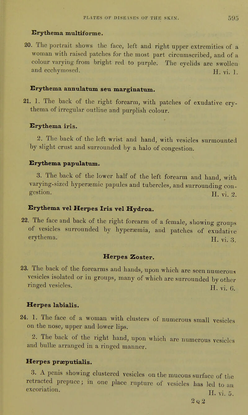 PLATES 01'' DISEASKS OV 'Villi SICIN. Erythema multiforme. 20. The portrait shows tlie face, left and riglit upper extremities of a woman with raised patches for the most part circumscribed, and of a colour varying from bright red to purple. The eyelids are swolleu and ecchymosed. jj yj ] Erythema annulatum sen marginatum. 21. 1. The back of the right forearm, with patches of exudative ery- thema of irregular outline and purplish colour. Erythema iris. 2. The back of the left wrist and hand, with vesicles surmounted by slight crust and surrounded by a halo of congestion. Erythema papulatum. 3. The back of the lower half of the left forearm and hand, with varying-sized hypersemic papules and tubercles, and surrounding con- gestion. H. vi. 2. Erythema vel Herpes Iris vel Hydroa. 22. The face and back of the right forearm of a female, showing groups of vesicles surrounded by hyperaemia, and patches of exudatiAe erythema. ^ 3 Herpes Zoster. 23. The back of the forearms and hands, upon which are seen numerous vesicles isolated or in groups, many of which are surrounded by other ringed vesicles. jj q Herpes labialis. 24. 1. The face of a woman with clusters of numerous small vesicles on the nose, upper and lower lips. 2. The back of the right hand, upon which are numerous vesicles and bullee arranged in a ringed manner. Herpes prseputialis. 3. A penis showing clustered vesicles on the mucous surface of tl retracted prepuce; in one place rupture of vesicles has led to i le in excoriation. tt • ^ il. VI. o 2(i2