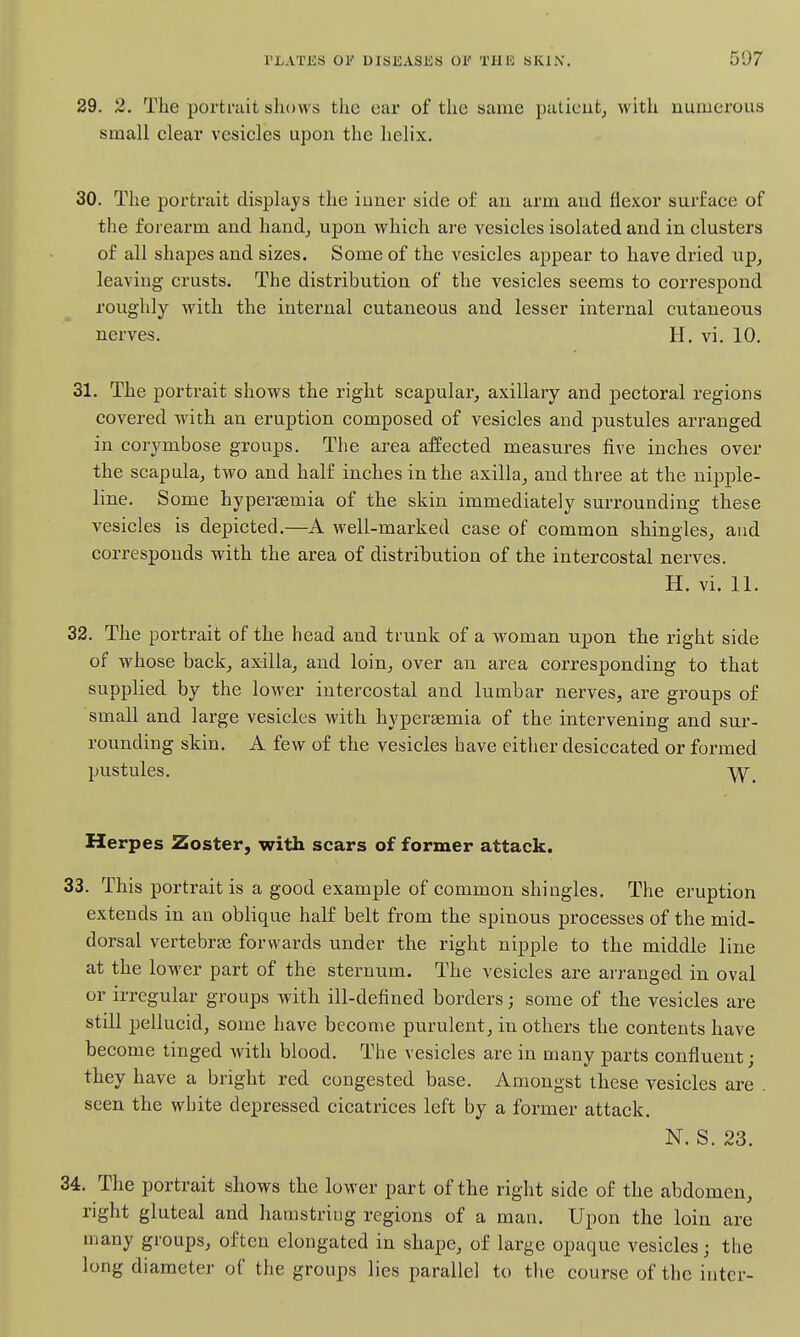 29. 2. The portrait shows the ear of the same patieut^ with numerous small clear vesicles upon the helix. 30. The portrait displays the inner side of an arm and flexor surface of the forearm and hand^ upon which are vesicles isolated and in clusters of all shapes and sizes. Some of the vesicles appear to have dried up, leaving crusts. The distribution of the vesicles seems to correspond roughly with the internal cutaneous and lesser internal cutaneous nerves. H. vi. 10. 31. The portrait shows the right scapular, axillary and pectoral regions covered with an eruption composed of vesicles and pustules arranged in corymbose groups. The area affected measures five inches over the scapula, two and half inches in the axilla, and three at the nipple- line. Some hypersemia of the skin immediately surrounding these vesicles is depicted.—A well-marked case of common shingles, aud corresponds with the area of distribution of the intercostal nerves. H. vi. 11. 32. The portrait of the head and trunk of a woman upon the right side of whose back, axilla, and loin, over an area corresponding to that supplied by the lower intercostal and lumbar nerves, are groups of small and large vesicles with hyperaemia of the intervening and sur- rounding skin. A few of the vesicles have either desiccated or formed pustules. -yy^ Herpes Zoster, with scars of former attack. 33. This portrait is a good example of common shingles. The eruption extends in an oblique half belt from the spinous processes of the mid- dorsal vertebrae forwards under the right nipple to the middle line at the lower part of the sternum. The vesicles are arranged in oval or irregular groups witli ill-defined borders; some of the vesicles are still pellucid, some have become purulent, in others the contents have become tinged with blood. The vesicles are in many parts confluent; they have a bright red congested base. Amongst these vesicles are . seen the white depressed cicatrices left by a former attack. N. S. 23. 34. The portrait shows the lower part of the right side of the abdomen, right gluteal and hamstring regions of a man. Upon the loin are many groups, often elongated in shape, of large opaque vesicles; the long diameter of the groups lies parallel to the course of the inter-