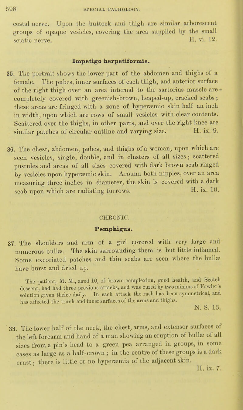 costal nerve. Upon the buttock and tliigh are similar arborescent groups of opaque vesicles, covering tlie area supplied by the small sciatic nerve. H. vi. 12. Impetigo herpetiformis. 35. Tlie portrait shows the lower part of the abdomen and thighs of a female. The pnbes, inner surfaces of each thigh, and anterior surface of the right thigh over an area internal to the sartorius muscle are- completely covered with greenish-brown, heaped-up, cracked scabs ; these areas are fringed with a zone of hypersemic skin half an inch in width, upon which are rows of small vesicles with clear contents. Scattered over the thighs, in other parts, and over the right knee are similar patches of circular outline and varying size. H. ix. 9. 36, The chest, abdomen, pubes, and thighs of a woman, upon which are seen vesicles, single, double, and in clusters of all sizes; scattered pustules and areas of all sizes covered with dark brown scab ringed by vesicles upon hypersemic skin. Around both nipples, over an area measuring three inches in diameter, the skin is covered with a dark scab upon which are radiating furrows, H. ix. TO. CHRONIC. Pemphigus. 37. The shoulders and arm of a girl covered >vith very large and numerous bullje. The skin surrounding them is but little inflamed. Some excoriated patches and thin scabs are seen where the bullae have burst and dried up. The patieut, M. M., aged 10, of brown complexion, good bealtli, and Scotch descent, had had three previous attacks, and was cured by two minims of Fowler's sokition given thrice daily. In each attack the rash has been symmetrical, and has affected the trunk and inner surfaces of the arms and thighs. N. S. 13. 33. The lower half of the neck, the chest, arms, and extensor surfaces of the left forearm and hand of a man showing an eruption of bullae of all sizes from a pin's head to a green pea arranged in groups, in some cases as large as a half-crown; in the centre of these groups is a dark crust: there is. little or no hypertemia of the adjacent skin. H. ix. 7.