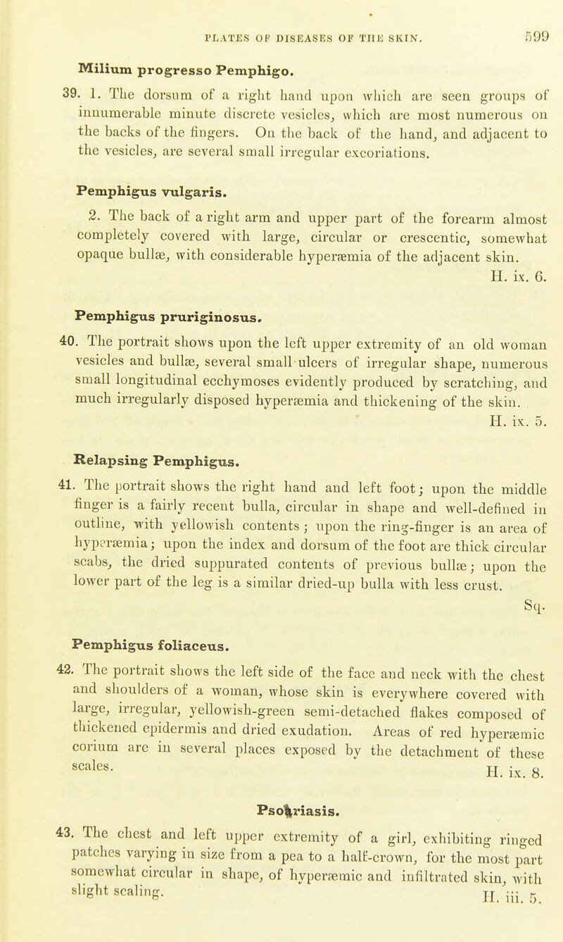 Milium progresso Pemphigo. 39. 1. The dorsum of a right hand upon which are seea groups of innumerable minute discrete vesicles^ which are most numerous on the backs of the fingers. On the back of the hand, and adjacent to the vesicles^ are several small irregular excoriations. Pemphigus vulgaris. 2. The back of a right arm and upper part of the forearm almost completely covered with large, circular or creseentic, somewhat opaque bullte, with considerable hyperemia of the adjacent skin. H. ix. 6. Pemphigus pruriginosus. 40. The portrait shows upon the left upper extremity of an old woman vesicles and bullae, several small ulcers of irregular shape, numerous small longitudinal ecchymoses evidently produced by scratching, and much irregularly disposed hypersemia and thickening of the skin. H. ix. 5. Relapsing Pemphigus. 41. The portrait shows the right hand and left foot; upon the middle finger is a fairly recent bulla, circular in shape and well-defined in outline, yvith yellowish contents ; upon the ring-finger is an area of hypersemia; upon the index and dorsum of the foot are thick circular scabs, the dried suppurated contents of previous bull^; upon the lower part of the leg is a similar dried-up bulla with less crust. Sq. Pemphigus foliaceus. 43. The portrait shows the left side of the face and neck with the chest and shoulders of a woman, whose skin is everywhere covered with large, irregular, yellowish-green semi-detached flakes composed of thickened epidermis and dried exudation. Areas of red hypersemic corium are in several places exposed by the detachment of these H. ix. 8. Pso%riasis. 43. The chest and left upper extremity of a girl, exhibiting ringed patches varying in size from a pea to a half-crown, for the most part somewhat circular in shape, of hyperaeraic and infiltrated skin, with slight scaling. jj •■■