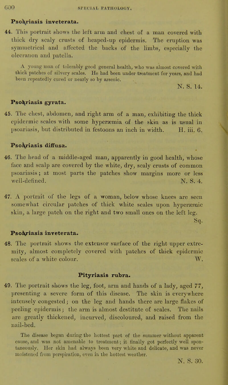 S1' K C1A L I'A T11 () LO Ci y. Pso\riasis inveterata. 44. This portrait shows the left arm and chest of a man covered with thick dry scaly crusts of lieaped-up epidermis. The eruption was symmetrical and affected the backs of the limbs^ especially the olecranon and patella. A young' man of tolerably good general health, who was almost covered with thick patches of silvery scales. He had been undei-^ treatment for years, and had been repeatedly cured or nearly so by aj-senic. N. S. 14. Psol^riasis gyrata. 45. The chest, abdomen, and right arm of a man, exhibitiog the thick epidermic scales with some hypersemia of the skin as is usual in psoariasisj but distributed in festoons an inch in width. H. iii. 6. Pso\riasis diffusa. 46. The head of a middle-aged man^ apparently in good health, whose face and scalp are covered by the white, dry, scaly crusts of common psoariasis; at most parts the patches show margins more or less well-defined. N. S. 4. 47. A portrait of the legs of a woman, below whose knees are seen somewhat circular patches of thick white scales upon hyperseraic skiuj a large patch on the right and two small ones on the left leg. Sq. Psoi^iasis inveterata. 48. The portrait shows the extensor surface of the right upper extre- mity, almost completely covered with patches of thick epidermic scales of a white colour. W. Pityriasis rubra. 49. The poi'traifc shows the leg, foot, arm and hands of a lady, aged 77, presenting a severe form of this disease. The skin is everywhere intensely congested; on the leg and hands there are large flakes of peeling epidermis; the arm is almost destitute of scales. The nails are greatly thickened, incurved, discoloured, and raised from the nail-bed. The disease began during the hottest part of the summer without apparent cause, and was not amenable to treatment; it iinally got perfectly well spon- taneously, ller skin had always been very white and delicate, and was never moistened from perspiration, even in the hottest weather. N. S. 30.