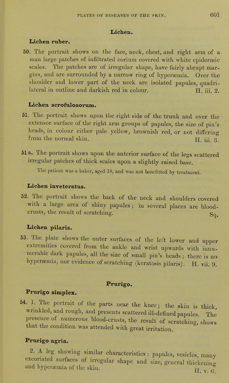 Lichen. Lichen ruber. 50. The portrait shows on the face, neck, chest, and right arm of a man large patches of infiltrated corium covered with white epidermic scales. The patches are of irregular shape, have fairly abrupt mar- gins, and are surrounded by a narrow ring of hyperajmia. Over the shoulder and lower part of the neck are isolated papules, quadri- lateral in outline and darkish red in colour. H. iii. 2. Lichen scrofulosorum. 51. The portrait shows upon the right side of the trunk and over the extensor surface of the right arm groups of papules, the size of pin's heads, in colour either pale yellow, brownish red, or not diflFering from the normal skin. H_ {{\ 3 51 a. The portrait shows upon the anterior surface of the legs scattered irregular patches of thick scales upon a slightly raised base. The patient was a baker, aged 18, and was not benefitted by treatment. Lichen inveteratus. 62. The portrait shows the back of the neck and shoulders covered with a large area of shiny papules; in several places are blood- crusts, the result of scratching. gq Lichen pilaris. 53. The plate shows the outer surfaces of the left lower and upper extremities covered from the ankle and wrist upwards with innu- merable dark papules, all the size of small pin's heads ; there is no hyperemia, nor evidence of scratching (keratosis pilaris). H. vii. 9. Prurigo. Prurigo simplex. 54. 1. The portrait of the parts near the knee; the skin is thick wnnkled, and rough, and presents scattered ill-defined papules The' presence of numerous blood-crusts, the result of scratching, shows that the condition was attended with great irritation. Prurigo agria. 2. A leg showing similar characteristics : papules, vesicles, many excoriated surfaces of irregular shape and size, general thickcniut and hyperaemia of the skiu. ,r ,T 11. V, 0.