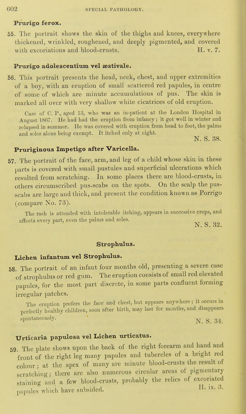 Prurigo ferox. 55. The portrait shows the skiu of the thighs and knees, everywhere thickened, wrinkled, roughened, and deeply pigmented, and covered with excoriations and blood-crusts. H. v. 7. Prurigo adolescentium vel aestivale. 56. This portrait presents the head, neck, chest, and upper extremities of a boy, with an eruption of small scattered red papules, in centre of some of which are minute accumulations of pus. The skin is marked all over with very shallow white cicatrices of old eruption. Case of C. P., aged 13, wlio was an in-patient at the London Hospital in Augaist 1867. He liad had the eruption from infancy ; it got well in winter and relaijsed in summer. Pie was covered with eruption from head to foot, the palms and soles alone being exempt. It itched only at night. N. S. 38. Pruriginous Impetigo after Varicella. 57. The portrait of the face, arm, and leg of a child whose skin in these parts is covered with small pustules and superficial ulcerations which resulted from scratching. In some places there are blood-crusts, in others circumscribed pus-scabs on the spots. On the scalp the pus- scabs are large and thick, and present the condition known as Porrigo (compare No. 73). The rash is attended with intolerable itching, appears in successive crops, and affects every part, even the palms and soles. N. S. 33. Strophulus. Lichen infantum vel Strophulus. 58. The portrait of an infant four months old, presenting a severe case of strophulus or red gum. The eruption consists of small red elevated ' papules, for the most part discrete, in some parts confluent forming irregular patches. The eruption prefers the face and chest, but appears anywhere ; it occurs in perfectly healthy children, soon after birth, may last for mouths, and disappears spontaneously. ' N S 34 Urticaria papulosa vel Lichen urticatus. 69. The plate shows upon the back of the right forearm and hand and front of the right leg many papules and tubercles o£ a bright red colour; at the apex of many are minute blood-crusts the result of scratching; there are also numerous circular areas of pigmentary staining and a few blood-crusts, probably the relics of excoriated papules which have subsided. ^-