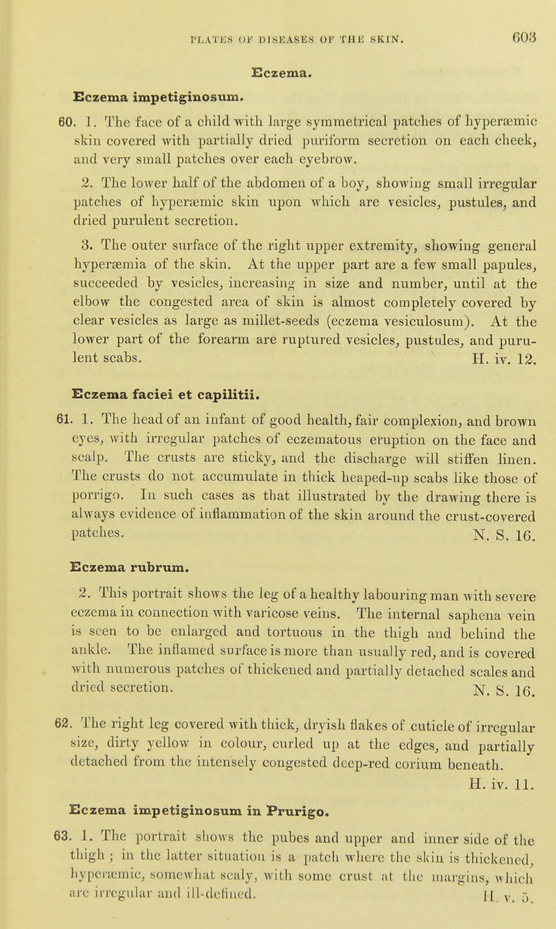 603 Eczema. Eczema impetiginosum. 60. 1. The face of a child with large symmetrical patches of hypera3mic skin covered with partially dried puriform secretion on each cheek, and very small patches over each eyebrow. 2. The lower half of the abdomen of a boy^ showing small irregular patches of hyjDercemic skin upon which are vesicles^ pustules, and dried purulent secretion. 3. The outer surface of the right upper extremity, showing general hyperaemia of the skin. At the upper part are a few small papules, succeeded by vesicles, increasing' in size and number, until at the elbow the congested area of skin is almost completely covered by clear vesicles as large as millet-seeds (eczema vesiculosum). At the lower part of the forearm are ruptured vesicles, pustules, and puru- lent scabs. H. iv. 13. Eczema faciei et capilitii. 61. 1. The head of an infant of good health, fair complexion, and brown eyes, with irregular patches of eczematous eruption on the face and scalp. The crusts are sticky, and the discharge will stiffen linen. The crusts do not accumulate in thick heaped-up scabs like those of porrigo. In such cases as that illustrated by the drawing there is always evidence of inflammation of the skin around the crust-covered patches. N. S. 16. Eczema rubrum. 2. This portrait shows the leg of a healthy labouring man with severe eczema in connection with varicose veins. The internal saphena vein is seen to be enlarged and tortuous in the thigh and behind the ankle. The inflamed surface is more than usually red, and is covered with numerous patches of thickened and partially detached scales and dried secretion. g jq^ 62. The right leg covered with thick, dryish flakes of cuticle of irregular size, dirty yellow in colour, curled up at the edges, and partially detached from the intensely congested deep-red corium beneath. H. iv, 11, Eczema impetiginosum in Prurigo. 63. 1. The portrait shows the pubes and upper and inner side of the thigh ; in the latter situation is a patch where the skin is thickened, hyperaimic, somewhat scaly, with some crust at the margins, which