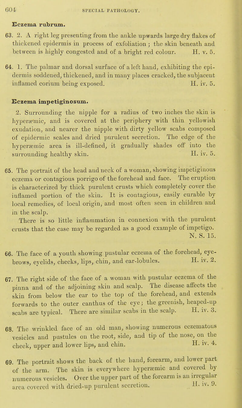 (301. Eczema rubrum. 63. 2. A rig-lit leg presenting from the ankle upwards large dry flakes of thickened epidermis in process of exfoliation ; the skin beneath and between is highly congested and of a bright red colour. H. v. 5. 64. 1. The palmar and dorsal surface of a left hand; exhibiting the epi- dermis soddened, thickened, and in many places cracked, the subjacent inflamed corium being exposed. H. iv. 5. Eczema impetiginosum. 2. Surrounding the nipple for a radius of two inches the skin is liypersemicj and is covered at the periphery with thin, yellowish exudation, and nearer the nipple with dirty yellow scabs composed of epidermic scales and dried purulent secretion. The edge of the hypersemic area is ill-defined, it gradually shades off into the surrounding healthy skin. H. iv. 5. 65. The portrait of the head and neck of a woman, showing impetiginous eczema oi' contagious porrigo of the forehead and face. The eruption is characterized by thick purulent crusts which completely cover the inflamed portion of the skin. It is contagious, easily curable by local remedies, of local origin, and most often seen in children and in the scalp. There is so little inflammation in connexion with the purulent crusts that the case may be regarded as a good example of impetigo. N. S. 15. 66. The face of a youth showing pustular eczema of the forehead, eye- brows, eyelids, cheeks, lips, chin, and ear-lobules. H. iv. 2. 67. The right side of the face of a woman with pustular eczema of the pinna and of the adjoining skin and scalp. The disease affects the skin from below the ear to the top of the forehead, and extends forwards to the outer canthus of the eye; the greenish, heaped-up scabs are typical. There are similar scabs in the scalp. H. iv. 3. 68. The wrinkled face of an old man, showing numerous eczematous vesicles and pustules on the root, side, and tip of the nose, on the cheek, upper and lower lips, and chin. H. iv. 4. 69. The portrait shows the back of the hand, forearm, and lower part of the arm. The skin is everywhere hypersemic and covered by numerous vesicles. Over the upper part of the forearm is an irregular