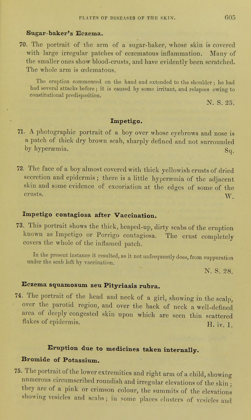 Sugar-baker's Eczema. 70. The portrait of the arm of a sugar-baker, whose skin is covered with large irregular patches of eczeraatous inflammation. Many of the smaller ones show blood-crusts, and have evidently been scratched. The whole arm is cedematous. The eruption commenced on the hand and extended to the shoulder ; he had had several attacks before ; it is caused by some irritant, and relapses owing to constitutional predisposition. N. S. 25. Impetigo. 71. A photographic portrait of a boy over whose eyebrows and nose is a patch of thick dry brown scab, sharply defined and not surrounded by hyperaemia. gq^ 72. The face of a boy almost covered with thick yellowish crusts of dried secretion and epidermis; there is a little hyperaemia of the adjacent skin and some evidence of excoriation at the edges of some of the crusts. Impetigo contagiosa after Vaccination, 73. This portrait shows the thick, heaped-up, dirty scabs of the eruption known as Impetigo or Porrigo contagiosa. The crust completely covers the whole of the inflamed patch. In the present instance it resulted, as it not unfrequently does, from suppuration under the scab left by vaccination. N. S. 28. Eczema squamosum seu Pityriasis rubra. 74. The portrait of the head and neck of a girl, showing in the scalp, over the parotid region, and over the back of neck a well-defined area of deeply congested skin upon which are seen thin scattered flakes of epidermis. j_j j Eruption due to medicines taken internally. Bromide of Potassium. 75. The portrait of the lower extremities and right arm of a child, showing numerous circumscribed roundish and irregular elevations of the skin ; they are of a pink or crimson colour, the summits of the elevations showing vesicles and scabs; iu .^omc places clusters of vesicles and