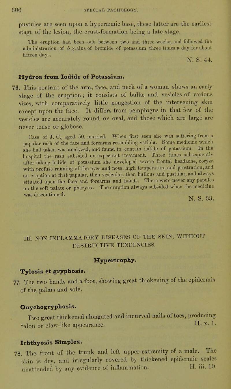 pustules are seen upon a liyperyeinic base, these latter ai'e the earliest stage of the lesion, the crust-formation being a late stage. The eruption Lad been out between two and three weeks, and followed the administration of 5 grains of bromide of potassium three times a day for about fifteen days. N. S, 44. Hydroa from Iodide of Potassium. 76. This portrait of the arm, face, and neck of a woman shows an early stage of the eruption; it consists of bullae and vesicles of various sizes, with comparatively little congestion of the intervening skin except upon the face. It differs from pemphigus in that few of the vesicles are accurately round or oval, and those which are large are never tense or globose. Case of J. C, aged 50, married. When first seen she was suffering from a papular rash of the face and forearms resembling variola. Some medicine which she had taken was analyzed, and found to contain iodide of potassium. In the hospital the rash subsided on expectant treatment. Three times subsequently after taking iodide of potassium she developed severe frontal headache, coryza with profuse running of the eyes and nose, high temperature and prostration, and an eruption at first papular, then vesicular, then bullous and pustular, and always situated upon the face and forearms and hands. There were never any papules on the soft palate or pharynx. The eruption always subsided when the medicine was discontinued. _ III. NON-INFLAMMATORY DISEASES OF THE SKIN, WITHOUT DESTRUCTIVE TENDENCIES. Hypertrophy. Tylosis et gryphosis. 77. The two hands and a foot, showing great thickening of the epidermis of the palms and sole. Onychogryphosis. Two great thickened elongated and incurved nails of toes, producing talon or claw-like appearance. H. x. 1. Ichthyosis Simplex. 78. The front of the trunk and left upper extremity of a male. The skin is dry, and irregularly covered by thickened epidermic scales