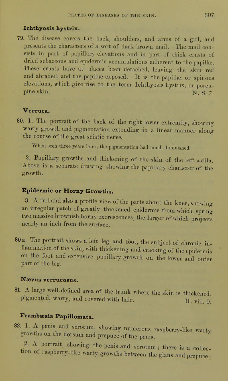 Ichthyosis hystrix. 79. The disease covers the back, shouklers, and arms of a girl, and presents the cliaracters of a sort of dark brown mail. The mail con- sists in part of papillary elevations and in part of thick crusts of dried sebaceous and epidermic accumulations adherent to the papiilje. These crusts have at places been detached, leaving the skin red and abraded, and the papillae exposed. It is the papillje, or spinous elevations, which give rise to the term Ichthyosis hystrix, or porcu- pine skin. ]Nj_ g_ 7 Verruca. 80. 1. The portrait of the back of the right lower extremity, sliowing warty growth and pigmentation extending in a linear manner along the course of the great sciatic nerve. When seen three years later, the pigmentation had much diminished. 2. Papillary growths and thickening of the skin of the left axilla. Above is a separate drawing showing the papillary character of the growth. Epidermic or Horny Growths. 3. A full and also a profile view of the parts about the knee, showing an irregular patch of greatly thickened epidermis from which spring two massive brownish horny excrescences, the larger of which projects nearly an inch from the surftice. 80 a. The portrait shows a left leg and foot, the subject of chronic in- flammation of the skin, with thickening and cracking of the epidermis on the foot and extensive papillary growth on the lower and outer part of the leg. Naevus verrucosus. 81. A large well-defined area of the trunk where the skin is thickened pigmented, warty, and covered with hair. H. viii. 9^ Frambsesia Papillomata. 82. 1. A penis and scrotum, showing numerous raspberry-like warty growths on the dorsum and prepuce of the penis. 2. A portrait, showing the penis and scrotum; there is a collec- tion of raspberry-like warty growths between the glans and prepuce;