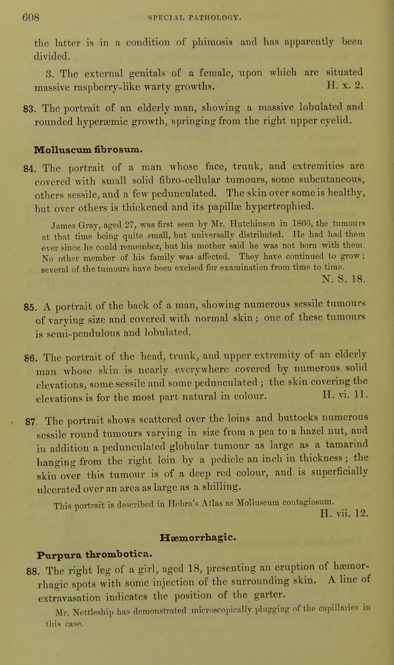 the latter is in a condition of phimosis and has apparently been divided. 3. The external genitals of a female, upon wliich are situated massive raspberry-like warty growths. H. x. 2. 83. The portrait of an elderly man, showing a massive lobulated and rounded hypersemic growth, springing from the right upper eyelid. MoUuscum fibrosum. 84. The portrait of a man whose face, trunk, and extremities are covered with small solid fibro-cellular tumours, some subcutaneous, others sessile, and a few pedunculated. The skin over some is healthy, but over others is thickened and its papillse bypertrophied. .Tames Gray, aged 27, was first seen by Mr. Hutchinson in 1860, the tumours at that time being quite pmall, but universally distributed. He had had them ever since he could remember, but his mother said he was not born with them. No other member of his family was atFected. They have continued to grow; several of the tumours have been excised for examination from time to time. N. S. 18. 85. A portrait of the back of a man, showing numerous sessile tumours of varying size and covered witb normal skin; one of these tumours is semi-pendulous and lobulated. 86. The portrait of the head, trunk, and upper extremity of an elderly man wbose skin is nearly everywhere covered by numerous solid elevations, some sessile and some pedunculated ; the skin covering the elevations is for the most part natural in colour. H. vi. 11. 87. The portrait shows scattered over the loins and buttocks numerous sessile round tumours varying in size from a pea to a hazel nut, and in addition a pedunculated globular tumour as large as a tamarind hanging from the right loin by a pedicle an inch in thickness; the skiu^'over this tumour is of a deep red colour, and is superficially ulcerated over an area as large as a shilling. This portrait is described in Hebra's Atlas as Molluscum contagiosum. H. vii. 12. Hamorrhagic. Purpura thrombotica. 88. The right leg of a girl, aged 18, presenting an eruption of haeraor- rhagic spots with some injection of the surrounding skin. A line of extravasation indicates the position of the garter. Mr. Nottla«.hi]. has demonstrated microscopicaUy plugging of the capillario? in tliis case.