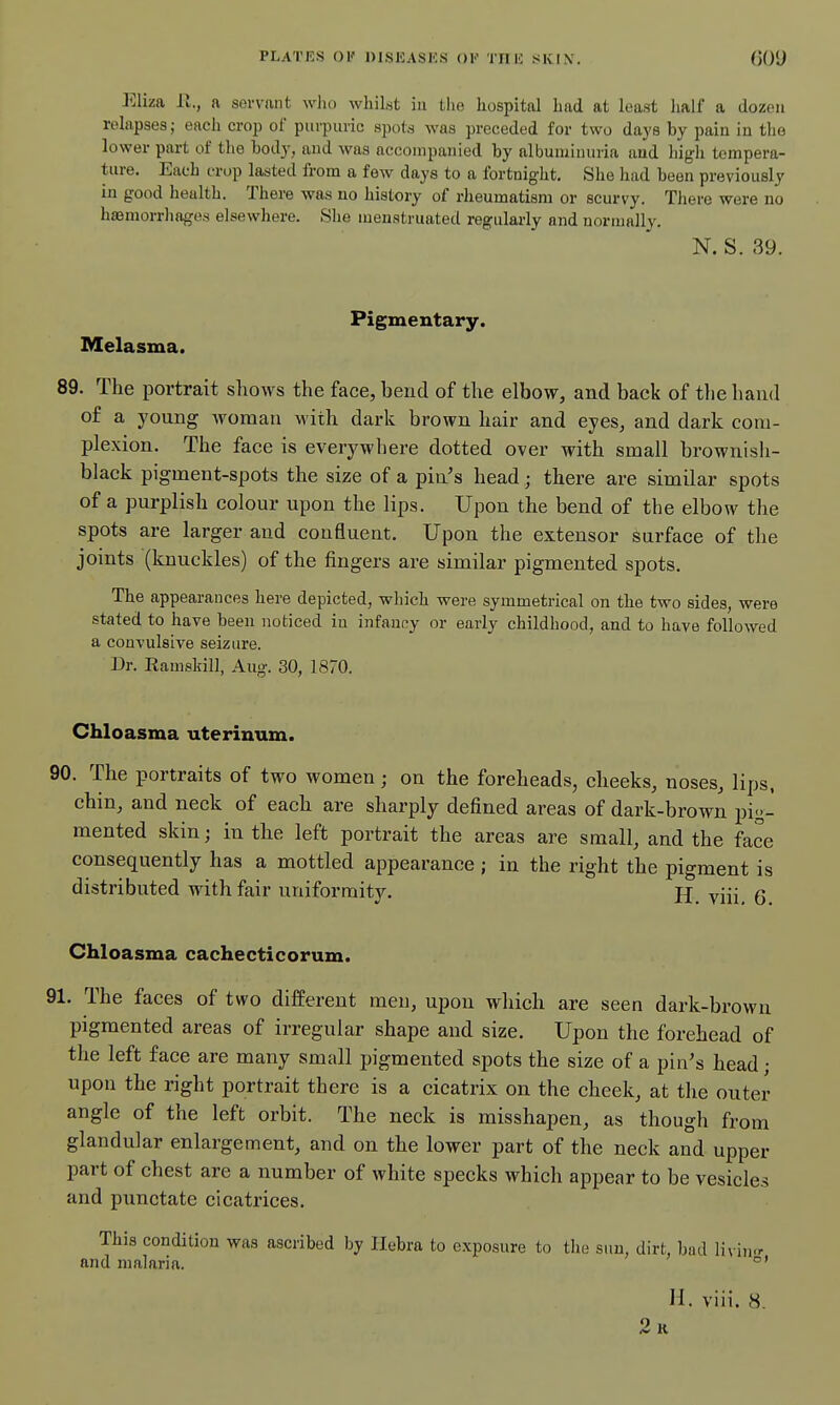 Eliza 11., a servant who whilst in the hospital had at least lialf a dozen relapses; each crop of purpuric spots Avas preceded for two days by pain in the lower part of the bodj', and was accompanied by albuminuria and hig-h tempera- ture. Each crop lasted from a few days to a fortnight. She had been previously in good health. There was no history of rheumatism or scurvy. There were no hffimorrliages elsewhere. She menstruated regularly and normally. N. S. 39. Pigmentary. Melasma. 89. The portrait shows the face, bend of the elbow, and back of the hand of a young Avoraan with dark brown hair and eyes, and dark com- plexion. The face is everywhere dotted over with small brownish- black pigment-spots the size of a pin's head; there are similar spots of a purplish colour upon the lips. Upon the bend of the elbow the spots are larger and confluent. Upon the extensor surface of the joints (knuckles) of the fingers are similar pigmented spots. Tbe appearances here depicted, which were symmetrical on the two sides, were stated to have been noticed in infancy or early childhood, and to have followed a convulsive seizure. Dr. Kamskill, Aug. 30, 1870. Chloasma uterinum. 90. The portraits of two women j on the foreheads, cheeks, noses, lips, chin, and neck of each are sharply defined areas of dark-brown pig- mented skin; in the left portrait the areas are small, and the face consequently has a mottled appearance ; in the right the pigment is distributed with fair uniformity. jj viii, 6 Chloasma cachecticorum. 91. The faces of two different men, upon which are seen dark-brown pigmented areas of irregular shape and size. Upon the forehead of the left face are many small pigmented spots the size of a pin's head; upon the right portrait there is a cicatrix on the cheek, at the outer angle of the left orbit. The neck is misshapen, as though from glandular enlargement, and on the lower part of the neck and upper part of chest are a number of white specks which appear to be vesicles and punctate cicatrices. This condition was ascribed by Ilebra to exposure to the sun, dirt, bad Myiwr and malaria. H. viii. 8. 2r