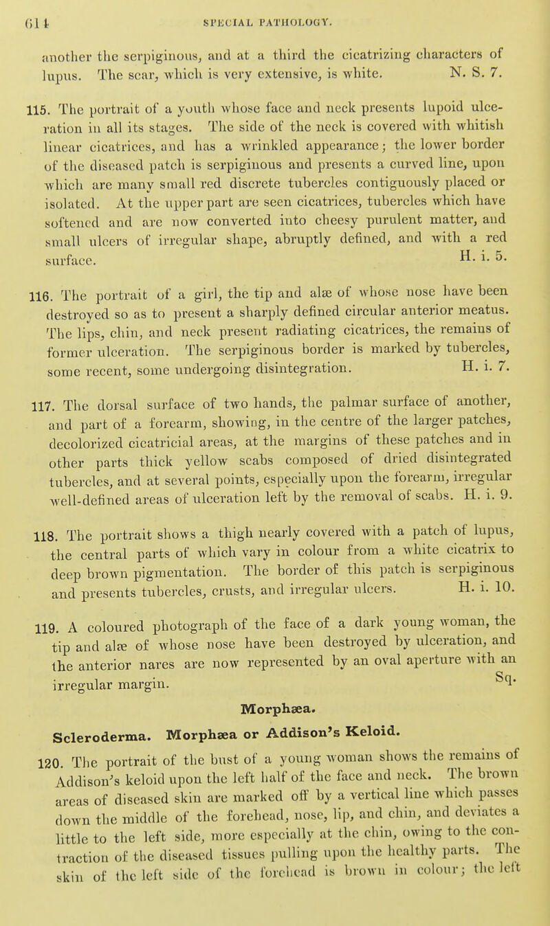 another tlie serpiginous, and at a third the cicatrizing cliaracters of lupus. The scar, whicli is very extensive, is white. N. S. 7. 115. The portrait of a youth whose face and neck presents lupoid ulce- ration in all its stages. The side of the neck is covered with whitish linear cicatrices, and has a wrinkled appearance; the lower border of the diseased patch is serpiginous and presents a curved line, upon which are many small red discrete tubercles contiguously placed or isolated. At the upper part are seen cicatrices, tubercles which have softened and are now converted into cheesy purulent matter, and small ulcers of irregular shape, abruptly defined, and Avith a red surface. ^* ^* 116. The portrait of a girl, the tip and alse of whose nose have been destroyed so as to present a sharply defined circular anterior meatus. The lips, chin, and neck present radiating cicatrices, the remains of former ulceration. The serpiginous border is marked by tubercles, some recent, some undergoing disintegration. H. i. 7. 117. The dorsal surface of two hands, the palmar surface of another, and part of a forearm, showing, in the centre of the larger patches, decolorized cicatricial areas, at the margins of these patches and in other parts thick yellow scabs composed of dried disintegrated tubercles, and at several points, especially upon the forearm, irregular well-defined areas of ulceration left by the removal of scabs. H. i. 9. 118. The portrait shows a thigh nearly covered with a patch of lupus, the central parts of which vary in colour from a white cicatrix to deep brown pigmentation. The border of this patch is serpiginous and presents tubercles, crusts, and irregular ulcers. H. i. 10. 119. A coloured photograph of the face of a dark young woman, the tip and alte of whose nose have been destroyed by ulceration, and the anterior nares are now represented by an oval aperture with an irregular margin. Morphsea. Scleroderma. Morphaea or Addison's Keloid. 120 The portrait of the bust of a young woman shows the remains of Addison^s keloid upon the left half of the face and neck. The brown areas of diseased skin are marked of!' by a vertical line which passes down the middle of the forehead, nose, lip, and chin, and deviates a little to the left side, more especially at the chin, owing to the con- traction of the diseased tissues pulling upon the healthy parts. The skin of the left side of the forehead is brown in colour; the left