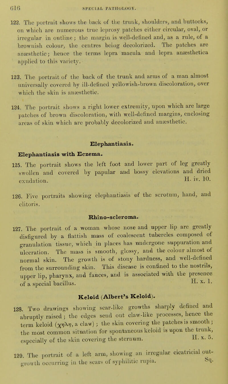 122. The portrait shows the hack of the trunk, sliouldei-s, and buttocks, on which are numerous true leprosy patches either circular, oval, or irregular in outline; the margin is well-defined and, as a rule, of a brownish colour, the centres being decolorized. The patches are anesthetic; hence the terms lepra macula and lepra ansesthetica applied to this variety. 123. The portrait of the back of the trunk and arms o£ a man almost nnivers ally covered by ill-defined yellowish-brown discoloration, over which the skin is anaesthetic. 124. The portrait shows a right lower extremity, upon which are large patches of brown discoloration, with well-defined margins, enclosing areas of skin which are probably decolorized and ansesthetic. Elephantiasis. Elephantiasis with Eczema. 125. The portrait shows the left foot and lower part of leg greatly swollen and covered by papular and bossy elevations and dried exudation. iv. 10. 126. Five portraits showing elephantiasis of the scrotum, hand, and clitoris. Rhino-scleroma. 127. The portrait of a woman whose nose and upper lip are greatly disfigured by a flattish mass of coalescent tubercles composed of granulation tissue, which in places has undergone suppuration and ulceration. The mass is smooth, glossy, and the colour almost of normal skin. The growth is of stony hardness, and well-defined from the surrounding skin. This disease is confined to the nostrils, upper lip, pharynx, and fauces, and is associated with the presence of a special bacillus. H. x. 1. Keloid (Albert's Keloid). 128. Two drawings showing scar-like growths sharply defined and abruptly raised; the edges send out claw-like processes, hence the term keloid (x'jM, a claw); the skin covering the patches is smooth; the most common situation for spontaneous keloid is upon the trunk, especially of the skin covering the sternum. H. x. 5. 129. The portrait of a left arm, showing an irregular cicatricial out- growth occurring in the scars of syphilitic rupia. Sq.