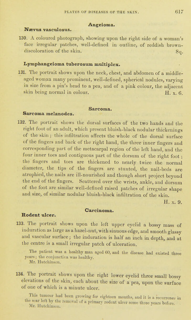 Angeioma. Naevus vasculosus. 130. A coloured pliotograpli, showing upon the right side of a woman^s face irregular patches^ well-defined in outline, of reddish brown- discoloration of the skin. Sq. Lymphangeioma tuberosum multiplex. 131. The portrait shows upon the neck, chest, and abdomen of a middle- aged woman many prominent, well-defined, spherical nodules, varying in size from a pin's head to a pea, and of a pink colour, the adjacent skin being normal in colour. H, x. 6. Sarcoma. Sarcoma melanodes. 132. The portrait shows the dorsal surfaces o£ the two hands and the right foot of an adult, which present bluish-black nodular thickenings of the skin; this infiltration affects the whole of the dorsal surface of the fingers and back of the right hand, the three inner fingers and corresponding part of the metacarpal region of the left hand, and the four inner toes and contiguous part of the dorsum of the right foot ; the fingers and toes are thickened to nearly twice the normal diameter, the tips of the fingers are stunted, the nail-beds are atrophied, the nails are ill-nourished and though short project beyond the end of the fingers. Scattered over the wrists, ankle, and dorsum of the foot are similar well-defined raised patches of irregular shape and size, of similar nodular bluish-black infiltration of the skin. H. X. 9. Carcinoma. Rodent ulcer. 133. The portrait shows upon the left upper eyelid a bossy mass of induration as large as a hazel-nut, with sinuous edge, and smooth glassy and vascular surface; the induration is half an inch in depth, and at the centre is a small irregular patch of ulceration. The patient was a healthy man aged 60, and the disease had existed three years; the conjunctiva was healthy. Mr. Hutchinson. 134. The portrait shows upon the right lower eyelid three small bossy elevations of the skin, each about the size of a pea, upon the surface of one of which is a minute ulcer. This tumour had been growing for eighteen months, and it is a recurrence in the scar left by the removal of a primary rodent ulcer some throe years before Mr. Hutchinson.