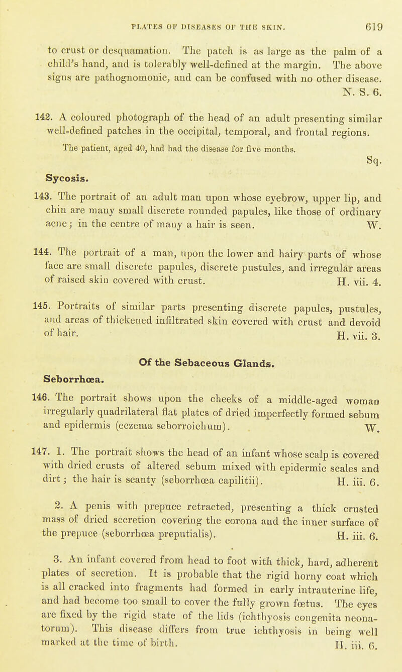 to crust or desqiianiiitioii. The patch is as large as the palm of a chillies hand, and is tolerably well-defined at the margin. The above signs are pathognomonic, and can be confused with no other disease. N. S. 6. 142. A coloured photograph of the head of an adult presenting similar well-defined patches in the occipital, temporal, and frontal regions. Tlie patient, aged 40, had had the disease for five months. Sq. Sycosis. 143. The portrait of an adult man upon whose eyebrow, upper lip, and chin are many small discrete rounded papules, like those of ordinary acne; in the centre of many a hair is seen. W. 144. The portrait of a man, upon the lower and hairy parts of whose face are small discrete papules, discrete pustules, and irregular areas of raised skin covered with crust. H. vii. 4. 145. Portraits of similar parts presenting discrete papules, pustules, and areas of thickened infiltrated skin covered with crust and devoid o^ hair. H. vii. 3. Of the Sebaceous Glands. Seborrhcea. 146. The portrait shows upon the cheeks of a middle-aged woman irregularly quadrilateral flat plates of dried imperfectly formed sebum and epidermis (eczema seborroichum). 147. 1. The portrait shows the head of an infant whose scalp is covered with dried crusts of altered sebum mixed with epidermic scales and dirt; the hair is scanty (seborrhcea capilitii). H. iii. 6. 2. A penis with prepuce retracted, presenting a thick crusted mass of dried secretion covering the corona and the inner surface of the prepuce (seborrhcea preputialis). H. iii. 6. 3. An infant covered from head to foot with thick, hard, adherent plates of secretion. It is probable that the rigid horny coat which is all cracked into fragments had formed in early intrauterine life, and had become too small to cover the fully grown fcetus. The eyes are fixed by the rigid state of the lids (ichthyosis congenita neona- torum). This disease differs from true ichthyosis in being well marked at the time of birth. II_ {[^ 5^