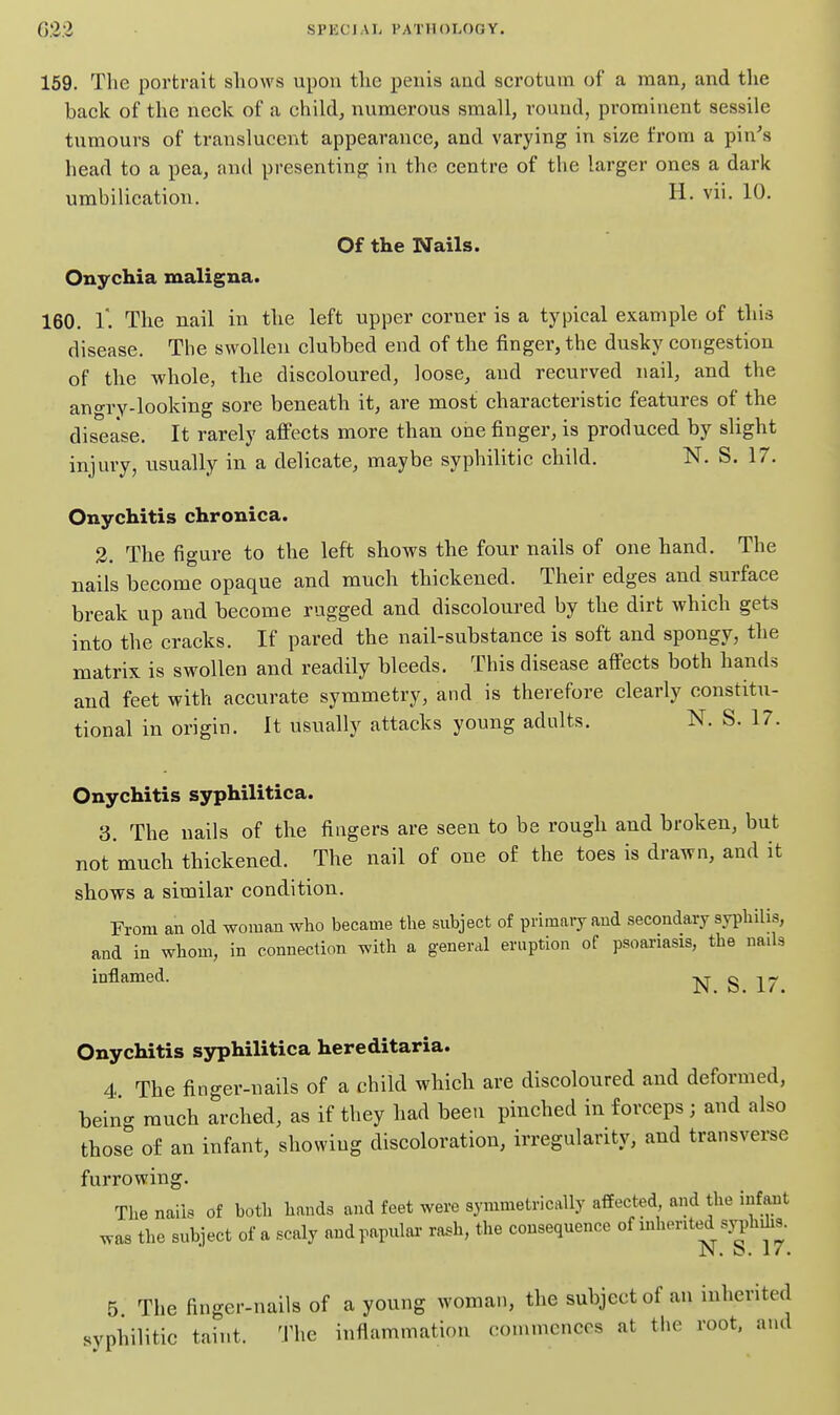 159. The portrait shows upon the penis and scrotum of a man, and the back of the neck of a child^ numerous small, round, prominent sessile tumours of translucent appearance, and varying in size from a pin's head to a pea, and presenting? in the centre of the larger ones a dark urabilication. H. vii. 10, Of the Nails. Onychia maligna. 160. 1*. The nail in the left upper corner is a typical example of this disease. The swollen clubbed end of the finger, the dusky congestion of the whole, the discoloured, loose, and recurved nail, and the angi\Y-looking sore beneath it, are most characteristic features of the disease. It rarely affects more than one finger, is produced by slight injury, usually in a delicate, maybe syphilitic child. N. S. 17. Onychitis chronica. 2. The figure to the left shows the four nails of one hand. The nails become opaque and much thickened. Their edges and surface break up and become rugged and discoloured by the dirt which gets into the cracks. If pared the nail-substance is soft and spongy, the matrix is swollen and readily bleeds. This disease affects both hands and feet with accurate symmetry, and is therefore clearly constitu- tional in origin. It usually attacks young adults. N. S. 17. Onychitis syphilitica. 3. The nails of the fingers are seen to be rough and broken, but not much thickened. The nail of one of the toes is drawn, and it shows a similar condition. From an old woman who became the subject of primary and secondary syphilis, and in whom, in connection with a general eruption of psoariasis, the nails inflamed. ^ Onychitis syphilitica hereditaria. 4 The finger-nails of a child which are discoloured and deformed, being much arched, as if they had been pinched in forceps; and also those of an infant, showing discoloration, irregularity, and transverse furrowing. The nails of both hands and feet were symmetrically affected and the infant was the subject of a scaly andpapulai- rash, the consequence of mhented syphUis. JN . 17. 5 The finger-nails of a young woman, the subject of an inherited syphilitic taint. The inflammation commences at tlie root, and