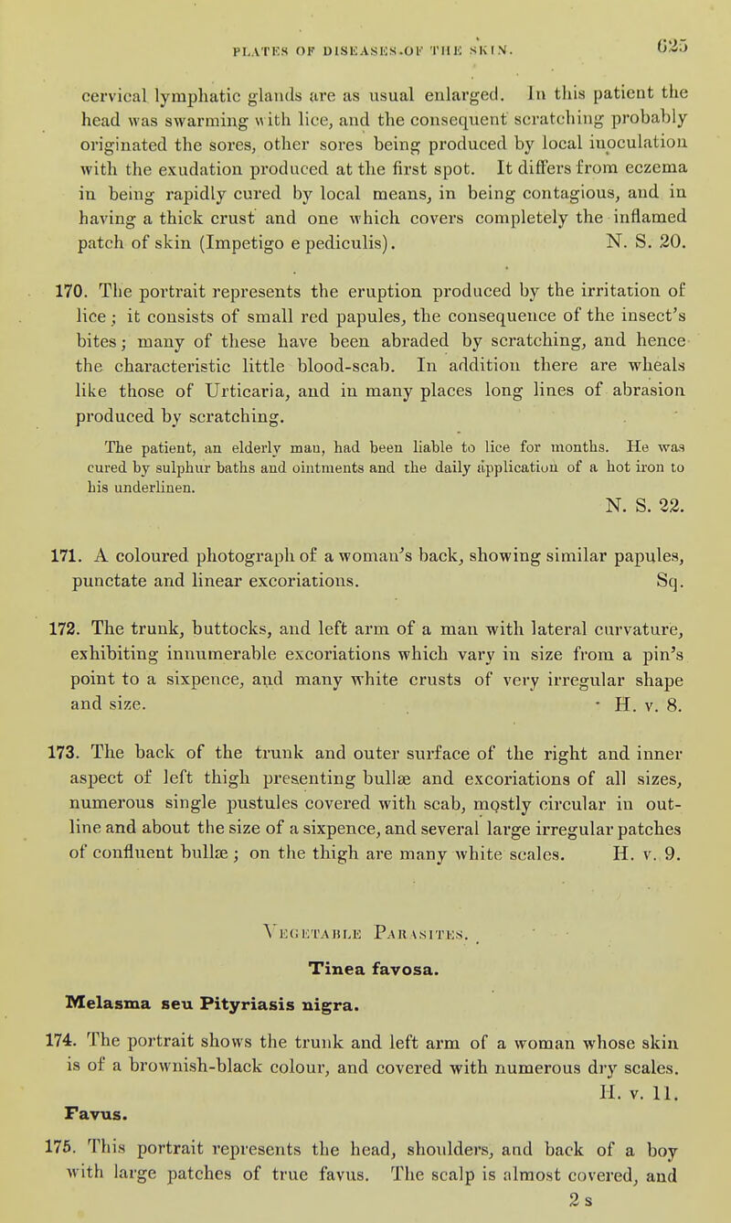 PLATES OF DlSliASES-Ol THE SKfN. G25 cervical lymphatic glands are as usual enlarged. In this patient the head was swarming with lice, and the consequent scratching probably originated the sores, other sores being produced by local inoculation with the exudation produced at the first spot. It differs from eczema in being rapidly cured by local means^ in being contagious, and in having a thick crust and one which covers completely the inflamed patch of skin (Impetigo e pediculis). N. S. 20. 170. The portrait represents the eruption produced by the irritation of lice ; it consists of small red papules, the consequence of the insect's bites; many of these have been abraded by scratching, and hence the characteristic little blood-scab. In addition there are wheals like those of Urticaria, and in many places long lines of abrasion produced by scratching. The patient, an elderly man, had been liable to lice for months. He was cured by sulphur baths and ointments and the daily tipplicatiuh of a hot iron to his underlinen. N. S. 22. 171. A coloured photograph of a womau^s back, showing similar papules, punctate and linear excoriations. Sq. 172. The trunk, buttocks, and left arm of a man with lateral curvature, exhibiting innumerable excoriations which vary in size from a pin's point to a sixpence, and many white crusts of very irregular shape and size. • H. v. 8. 173. The back of the trunk and outer surface of the right and inner aspect of left thigh presenting bullae and excoriations of all sizes, numerous single pustules covered with scab, mqstly circular in out- line and about the size of a sixpence, and several large irregular patches of confluent bullae ; on the thigh are many white scales. H. v. 9. A'egetajjle Parasites. _ Tinea favosa. Melasma seu Pityriasis nigra. 174. The portrait shows the trunk and left arm of a woman whose skin is of a brownish-black colour, and covered with numerous dry scales. H. V. 11. Favus. 176. This portrait represents the head, shoulders, and back of a boy with large patches of true favus. The scalp is almost covered, and 2s