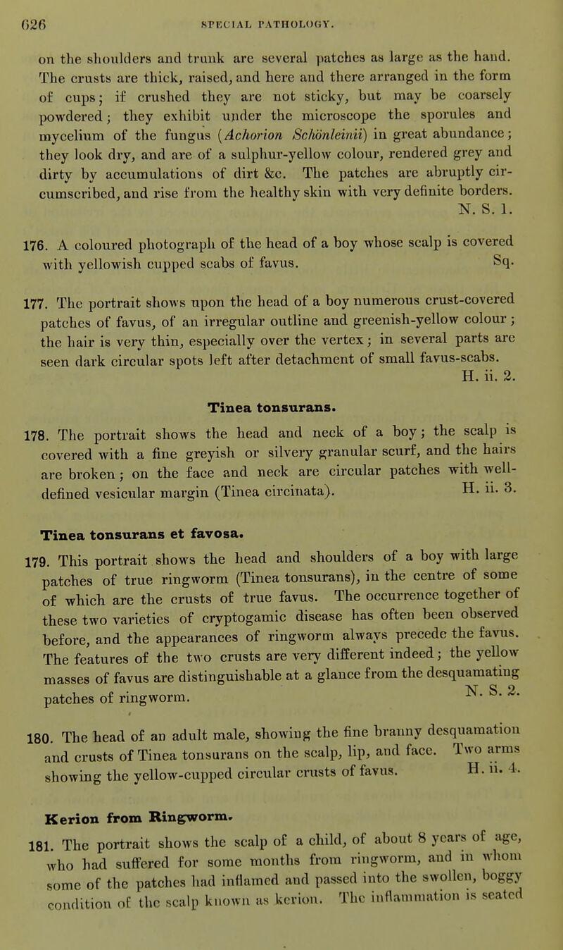 on the slioulclers and trunk are several patches as large as the hand. The crusts are thick, raised, and here and there arranged in the form of cups; i£ crushed they are not sticky, but may be coarsely powdered; they exhibit under the microscope the sporules and mycelium of the fungus {Achorion Schdnleinii) in great abundance; they look dry, and are of a sulphur-yellow colour, rendered grey and dirty by accumulations of dirt &c. The patches are abruptly cir- cumscribed, and rise from the healthy skin with very definite borders. N. S. 1. 176. A coloured photograph of the head of a boy whose scalp is covered with yellowish cupped scabs of favus. Sq. 177. The portrait shows upon the head of a boy numerous crust-covered patches of favus, of an irregular outline and greenish-yellow colour; the hair is very thin, especially over the vertex; in several parts are seen dark circular spots left after detachment of small favus-scabs. H. ii. 2. Tinea tonsurans. 178. The portrait shows the head and neck of a boy; the scalp is covered with a fine greyish or silvery granular scurf, and the hairs are broken; on the face and neck are circular patches with well- defined vesicular margin (Tinea circinata). H. n. 3. Tinea tonsurans et favosa. 179. This portrait shows the head and shoulders of a boy with large patches of true ringworm (Tinea tonsurans), in the centre of some of which are the crusts of true favus. The occurrence together of these two varieties of cryptogamic disease has often been observed before, and the appearances of ringworm always precede the favus. The features of the two crusts are very different indeed; the yellow masses of favus are distinguishable at a glance from the desquamating patches of ringworm. ^- ^- 180. The head of an adult male, showing the fine branny desquamation and crusts of Tinea tonsurans on the scalp, lip, and face. Two arms showing the yellow-cupped circular crusts of favus. H. ii. 4.. Kerion from Ringworm, 181. The portrait shows the scalp of a child, of about 8 years of age, who had suflFered for some months from ringworm, and in whom some of the patches had inflamed and passed into the swollen, boggy condition of the scalp known as kerion. The inflammation is seated