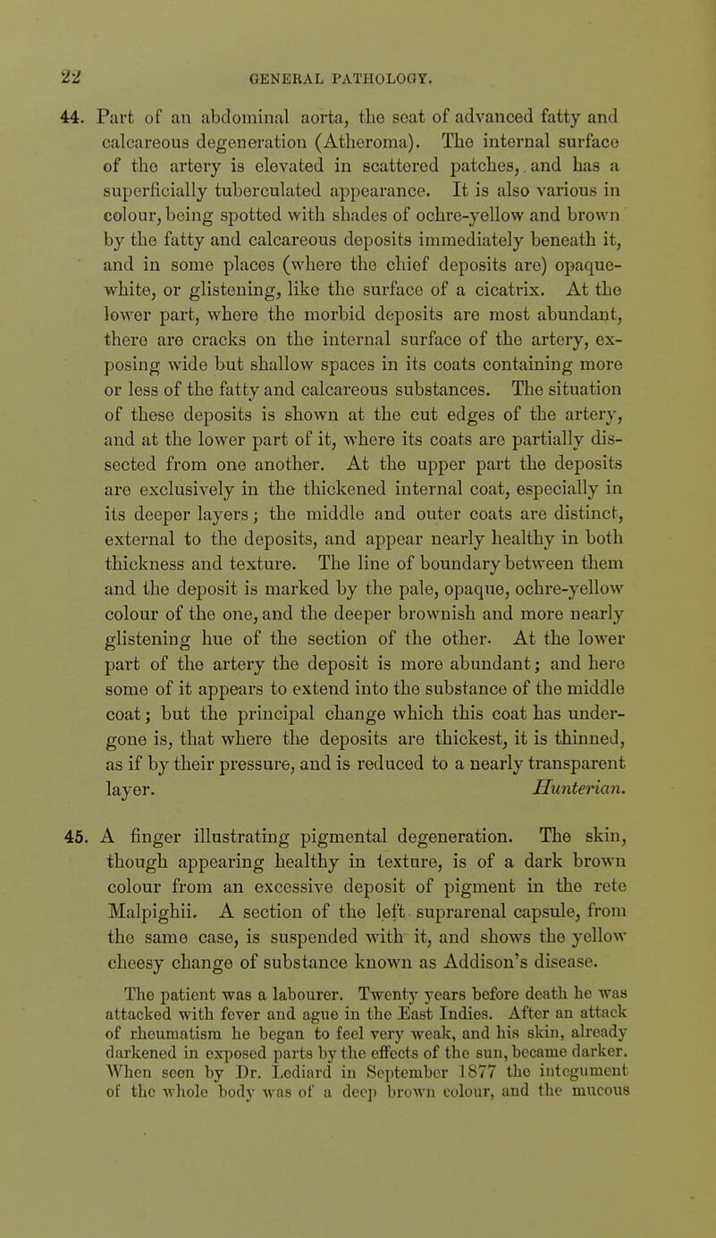 44. Part of an abdominal aorta, the seat of advanced fatty and calcareous degeneration (Atheroma). The intei-nal surface of the artery is elevated in scattered patches,.and has a superficially tuberculated appearance. It is also various in colour, being spotted with shades of ochre-yellow and brown by the fatty and calcareous deposits immediately beneath it, and in some places (where the chief deposits are) opaque- white, or glistening, like the surface of a cicatrix. At the lower part, where the morbid deposits are most abundant, there are cracks on the internal surface of the artery, ex- posing wide but shallow spaces in its coats containing more or less of the fatty and calcareous substances. The situation of these deposits is shown at the cut edges of the artery, and at the lower part of it, where its coats are partially dis- sected from one another. At the upper part the deposits are exclusively in the thickened internal coat, especially in its deeper layers; the middle and outer coats are distinct, external to the deposits, and appear nearly healthy in both thickness and texture. The line of boundary between them and the deposit is marked by the pale, opaque, ochre-yellow colour of the one, and the deeper brownish and more nearly glistening hue of the section of the other. At the lower part of the artery the deposit is more abundant; and here some of it appears to extend into the substance of the middle coat; but the principal change which this coat has under- gone is, that where the deposits are thickest, it is thinned, as if by their pressure, and is reduced to a nearly transparent layer. Hunterian. 45. A finger illustrating pigmental degeneration. The skin, though appearing healthy in texture, is of a dark brown colour from an excessive deposit of pigment in the rete Malpighii. A section of the left suprarenal capsule, from the same case, is suspended with it, and shows the yellow cheesy change of substance known as Addison's disease. The patient was a labourer. Twenty years before death he was attacked with fever and ague in the East Indies. After an attack of rheumatism he began to feel very weak, and his skin, already darkened in exposed parts by the eflPects of the sun, became darker. When seen by Dr. Lcdiard in September 1877 the integument of the whole body was of a deep brown colour, and the mucous