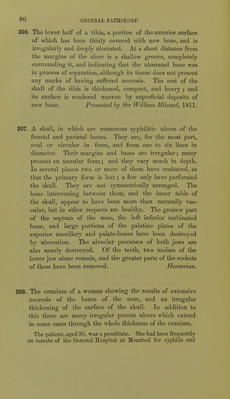 208. The lower half of a tibia, a portion of the anterior surface of which has been thinly covered with new bone, and is irregularly and deeply ulcerated. At a short distance from the margins of the ulcer is a shallow groove, completely surrounding it, and indicating that the ulcerated bone was in process of separation, although its tissue does not present any marks of having sutlered necrosis. The rest of the shaft of the tibia is thickened, compact, and heavy ; and its surface is rendered uneven by superficial deposits of new bone. Presented hy Sir William Blizard, 1811. 207. A skull, in which are numerous syphilitic ulcers of the frontal and parietal bones. They are, for the most part, oval or circular in form, and from one to six lines in diameter. Their margins and bases are irregular; many present an annular form; and they vary much in depth. In several places two or more of them have coalesced, so that the primary form is lost; a few only have perforated the skull. They are not symmetrically arranged. The bone intervening between them, and the inner table of the skull, appear to have been more than naturally vas- cular, but in other respects are healthy. The greater part of the septum of the nose, the left inferior turbinated bone, and large portions of the palatine plates of the superior maxillary and palate-bones have been destroyed by ulceration. The alveolar processes of both jaws are also nearly destroyed. Of the teeth, two molars of the lower jaw alone remain, and the greater parts of the sockets of these have been removed. Hunterian. 208. The cranium of a woman showing the results of extensive necrosis of the bones of the nose, and an irregular thickening of the surface of the skull. In addition to this there are many irregular porous ulcers which extend in some cases through the whole thickness of the cranium. The patient, aged 30, was a prostitute. She had been frequently an inmate of the General Hospital at Montreal for syphilis and