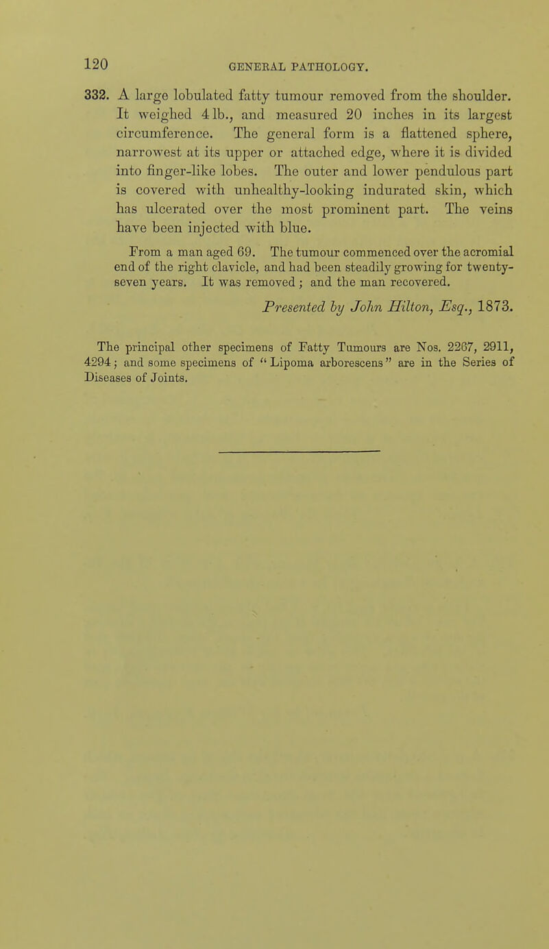 332. A large lobulated fatty tumour removed from the shoulder. It weighed 41b., and measured 20 inches in its largest circumference. The general form is a flattened sphere, narrowest at its upper or attached edge, where it is divided into finger-like lobes. The outer and lower pendulous part is covered with unhealthy-looking indurated skin, which has ulcerated over the most prominent part. The veins have been injected with blue. From a man aged 69. The tumour commenced over the acromial end of the right clavicle, and had been steadily growing for twenty- seven years. It was removed ; and the man recovered. Presented hy John Hilton, Esq., 1873. The principal other specimens of Fatty Tumours are Nos. 2267, 2911, 4294; and some specimens of  Lipoma arborescens are in the Series of Diseases of Joints.