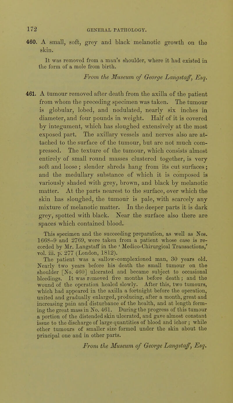 460. A small, soft, grey and black melanotic growth on the skin. Ifc was removed from a man's shoulder, where it had existed in the form of a mole from birth. From the Museum of George Langstaff, Esq. 461. A tumour removed after death from the axilla of the patient from whom the preceding specimen was taken. The tumour is globular, lobed, and nodulated, nearly six inches in diameter, and four pounds in weight. Half of it is covered by integument, which has sloughed extensively at the most exposed part. The axillary vessels and nerves also are at- tached to the surface of the tumour, but are not much com- pi'essed. The texture of the tumour, which consists almost entirely of small round masses clustered together, is very soft and loose; slender shreds hang from its cut surfaces; and the medullary substance of which it is composed is variously shaded with grey, brown, and black by melanotic matter. At the parts nearest to the surface, over which the skin has sloughed, the tumour is pale, with scarcely any mixture of melanotic matter. In the deeper parts it is dark grey, spotted with black. Near the surface also there are spaces which contained blood. This specimen and the succeeding preparation, as well as Nos. 1668-9 and 2769, were taken from a patient whose case is re- corded by Mr. Langstaflf in the ' Medico-Chirnrgical Transactions,' vol. iii. p. 277 (London, 1812). The patient was a sallow-complexioned man, 30 years old. Nearly two years before his death the small tumour on the shoulder [No. 460] ulcerated and became subject to occasional bleedings. It was removed five months before death; and the wound of the operation healed slowly. After this, two tumours, which had appeared in the axilla a fortnight before the operation, united and gradually enlarged, producing, after a month, great and increasing pain and disturbance of the health, and at length form- ing the great mass in No. 461. During the progress of this tumour a portion of the distended skin ulcerated, and gave almost constant issue to the discharge of large quantities of blood and ichor ; while other tumours of smaller size formed under the skin about the principal one and in other parts. From the Museum of George Langstaff, Esq.