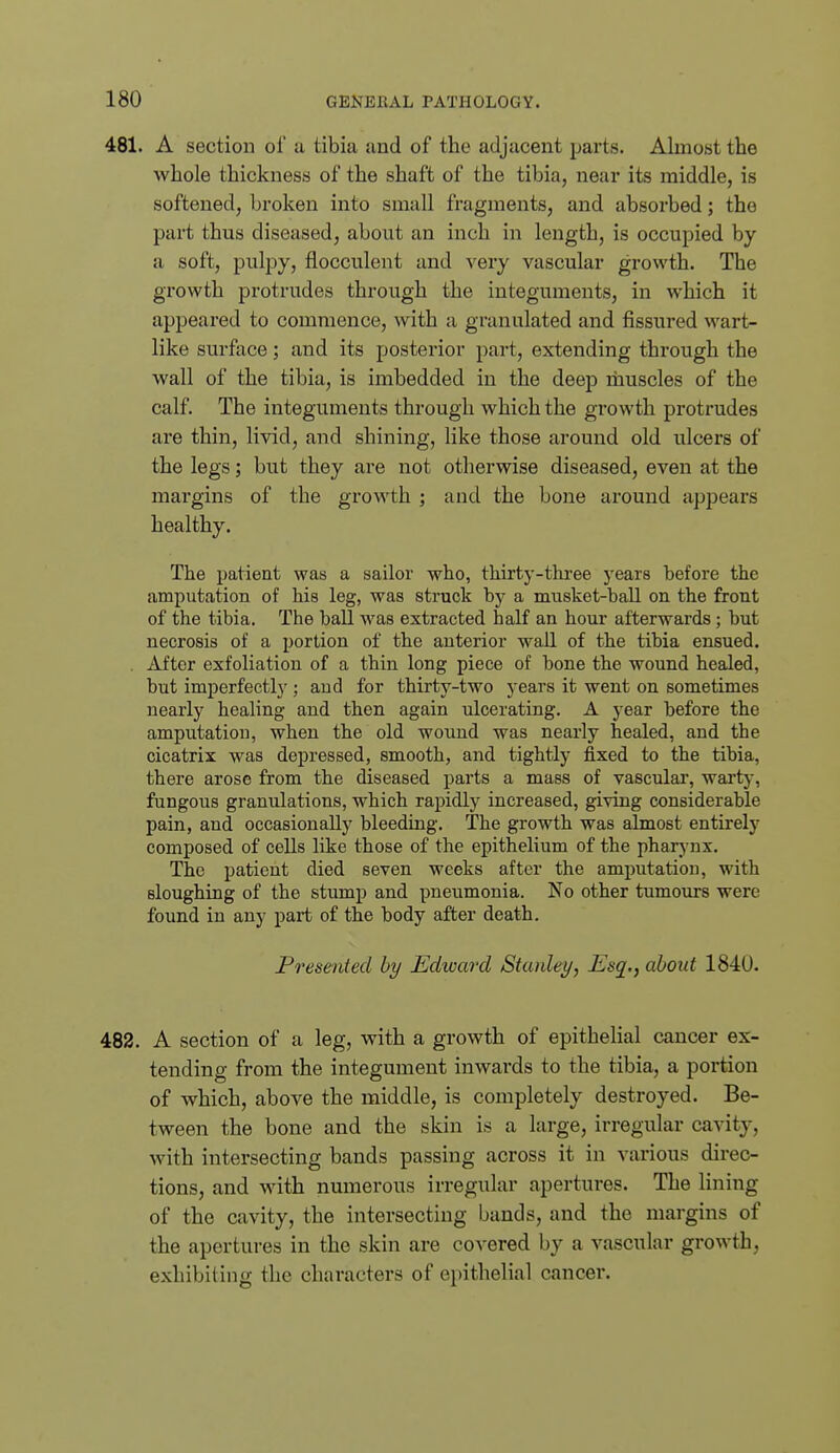 481. A section of a tibia and of the adjacent parts. Ahnost the whole thickness of the shaft of the tibia, near its middle, is softened, broken into small fragments, and absorbed; the part thus diseased, about an inch in length, is occupied by a soft, pulpy, flocculent and very vascular growth. The growth protrudes through the integuments, in which it appeared to commence, with a granulated and fissured wart- like surface; and its posterior part, extending through the wall of the tibia, is imbedded in the deej) muscles of the calf. The integuments through which the growth protrudes are thin, livid, and shining, like those around old ulcers of the legs; but they are not otherwise diseased, even at the margins of the growth ; and the bone around appears healthy. The patient was a sailor who, thirty-tlu-ee j'ears before the amputation of his leg, was struck by a musket-ball on the front of the tibia. The ball was extracted half an hour afterwards; but necrosis of a portion of the anterior wall of the tibia ensued. . After exfoliation of a thin long piece of hone the wound healed, but imperfectl}'; and for thirty-two years it went on sometimes nearly healing and then again ulcerating. A year before the amputation, when the old wound was nearly healed, and the cicatrix was depressed, smooth, and tightly fixed to the tibia, there arose from the diseased parts a mass of vascular, warty, fungous granulations, which rapidly increased, giving considerable pain, and occasionally bleeding. The growth was almost entirely composed of cells like those of the epithelium of the pharynx. The patient died seven weeks after the amputation, with sloughing of the stump and pneumonia. No other tumours were found in any part of the body after death. Presented by Edward Stanley, Esq., about 1840. 482. A section of a leg, with a growth of epithehal cancer ex- tending from the integument inwards to the tibia, a portion of which, above the middle, is completely destroyed. Be- tween the bone and the skin is a large, irregular cavity, with intersecting bands passing across it in various direc- tions, and with numerous irregular apertures. The lining of the cavity, the intersecting bands, and the margins of the apertures in the skin are covered by a vascular growth, exhibiting the characters of epithelial cancer.