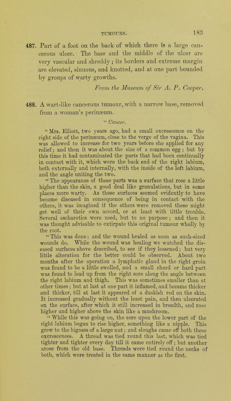 487. Part of a foot on the back of which there is a large can- cerous ulcer. The base and the middle of the ulcer are very vascular and shreddy; its borders and extreme margin are elevated, sinuous, and knotted, and at one part bounded by groups of warty growths. From the Museum of Sir A. P. Cooper, 488. A wart-lilve cancerous tumou:r, with a narrow base, removed from a woman's perinjeum.  Cancer.  Mrs. Elliott, two years ago, had a small excrescence on the right side of the perinseum, close to the verge of the vagina. This was allowed to increase for two years before she applied for any relief; and then it was about the size of a conamon egg ; but by this time it had contaminated the parts that had been continually in contact with it, which were the back end of the right labium, both externally and internally, with the inside of the left labium, and the angle uniting the two.  The appearance of these parts was a surface that rose a little higher than the skin, a good deal like granulations, but in some places more warty. As these surfaces seemed evidently to have become diseased in consequence of being in contact with the others, it was imagined if the others were removed these might get well of their own accord, or at least with little trouble. Several escharotics were used, but to no purpose; and then it •was thought advisable to extirpate this original tumour wholly by the root.  This was done; and the wound healed as soon as such-sized wounds do. While the wound was healing we watched the dis- eased surfaces above described, to see if they lessened; but very little alteration for the better could be observed. About two months after the operation a lymphatic gland in the right groin was found to be a little swelled, and a small chord or hard part was found to lead up from the right sore along the angle between the right labium and thigh. This was sometimes smaller than at other times; but at last at one part it inflamed, and became thicker and thicker, till at last it appeared of a duskish red on the skin. It increased gradually without the least pain, and then ulcerated on the surface, after which it still increased in breadth, and rose higher and higher above the skin like a mushroom.  While this was going on, the sore upon the lower part of the right labium began to rise higher, something like a nipple. This grew to the bigness of a large nut; and sloughs came off both these excrescences. A thread was tied round this last, which Avas tied tighter and tighter every day till it came entirely off; but another arose from the old base. Threads were tied round the necks of both, which wore treated in the same manner as the first.