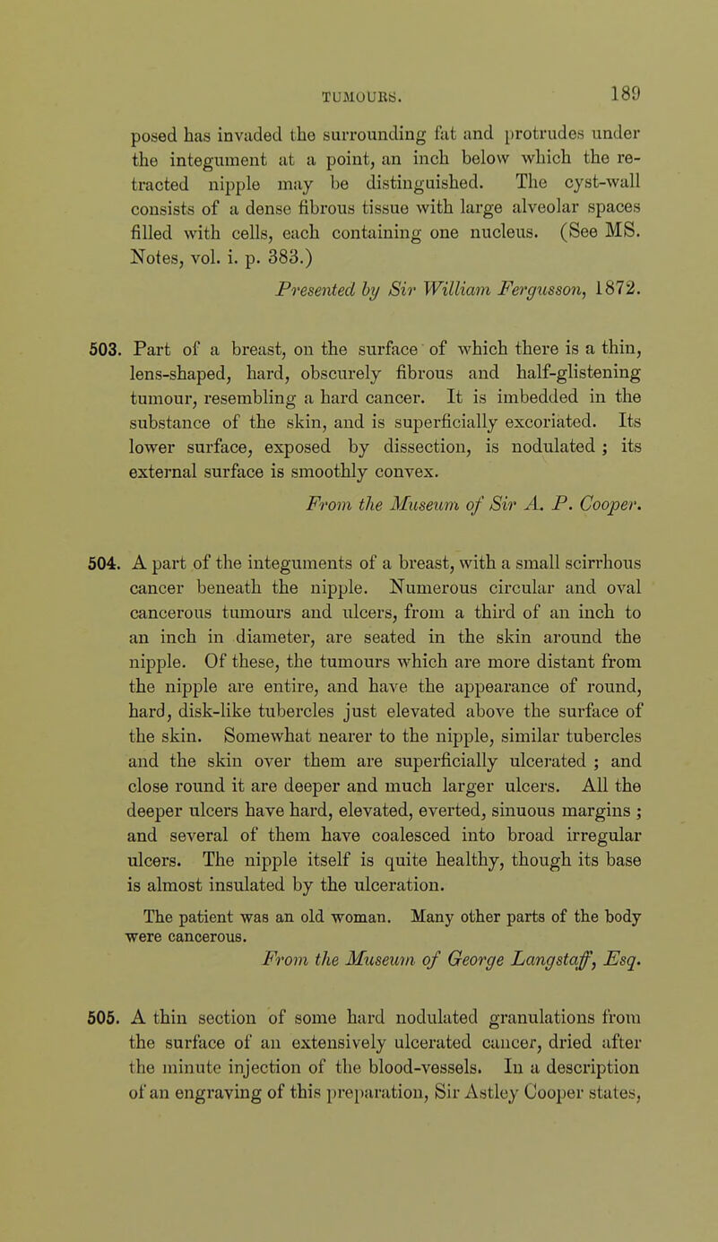 posed has invaded the surrounding fat and protrudes under the integument at a point, an inch below which the re- tracted nipple may be distinguished. The cyst-wall consists of a dense fibrous tissue with large alveolar spaces filled with cells, each containing one nucleus. (See MS. Notes, vol. i. p. 383.) Presented by Sir William Fergusson, 1872. 603. Part of a breast, on the surface of which there is a thin, lens-shaped, hard, obscurely fibrous and half-glistening tumour, resembling a hard cancer. It is imbedded in the substance of the skin, and is superficially excoriated. Its lower surface, exposed by dissection, is nodulated ; its external surface is smoothly convex. From the Museum of Sir A. P. Cooper. 504. A part of the integuments of a breast, with a small scirrhous cancer beneath the nipple. Numerous circular and oval cancerous tumours and ulcers, from a third of an inch to an inch in diameter, are seated in the skin around the nipple. Of these, the tumours which are more distant from the nipple are entire, and have the appearance of round, hard, disk-like tubercles just elevated above the surface of the skin. Somewhat nearer to the nipple, similar tubercles and the skin over them are superficially ulcei-ated ; and close round it are deeper and much larger ulcers. All the deeper ulcers have hard, elevated, everted, sinuous margins ; and several of them have coalesced into broad irregular ulcers. The nipple itself is quite healthy, though its base is almost insulated by the ulceration. The patient was an old woman. Many other parts of the body were cancerous. From the Museum of George Langstaff, Esq. 605. A thin section of some hard nodulated granulations from the surface of an extensively ulcerated cancer, dried after the minute injection of the blood-vessels. In a description of an engraving of this preparation. Sir Astley Cooper states,