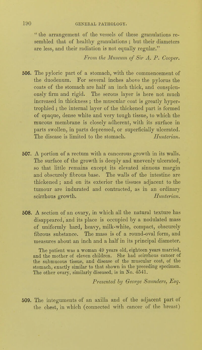  the arrangement of the vessels of these granulations re- sembled that of healthy granulations ; but their diameters are less, and their radiation is not equally regular. From the Museum of Sir A. P. Cooper. 506. The pyloric part of a stomach, with the commencement of the duodenum. For several inches above the pylorus the coats of the stomach are half an inch thick, and conspicu- ously firm and rigid. The serous layer is here not much increased in thickness ; the muscular coat is greatly hyper- trophied ; the internal layer of the thickened part is formed of opaque, dense white and very tough tissue, to which the mucous membrane is closely adherent, with its surface in parts swollen, in parts depressed, or superficially ulcerated. The disease is limited to the stomach. Hunterian. 507. A portion of a rectum with a cancerous growth in its walls. The surface of the growth is deeply and unevenly ulcerated, so that little remains except its elevated sinuous margin and obscurely fibrous base. The walls of the intestine are thickened; and on its exterior the tissues adjacent to the tumour are indurated and contracted, as in an ordinary scirrhous growth. Hunterian. 508. A section of an ovary, in which all the natural texture has disappeared, and its place is occupied by a nodulated mass of uniformly hard, heavy, milk-white, compact, obscurely fibrous substance. The mass is of a round-oval form, and measures about an inch and a half in its principal diameter. The patient was a woman 49 years old, eighteen years married, and the mother of eleven children. She had scirrhous cancer of the submucous tissue, and disease of the muscular coat, of the stomach, exactly similar to that shown in the preceding specimen. The other ovary, similarly diseased, is in Ko. 4541. Presented hy George Saunders, Esq. 609. The integuments of an axilla and of the adjacent part of the chest, in which (connectetl witli cancer of the breast)