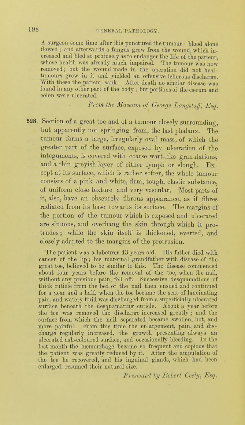 A surgeon some time after this punctured the tumour: blood alone flowed ; and afterwards a fungus grew from the wound, which in- creased and bled so profusel}^ as to endanger the life of the patient, whoso health was already much impaired. The tumour was now removed; but the wound made in the operation did not heal: tumours grew in it and yielded an off'onsivo ichorous discharge. With these the patient sank. After death no similar disease was found in any other part of the body ; but portions of the c^cum and colon were ulcerated. From the Museum of George Langstaff, Esq. 628. Section of a great toe and of a tumour closely surrounding, but apparently not springing from, the last phalanx. The tumour forms a large, irregularly oval mass, of which the greater part of the surface, exposed by ulceration of the integuments, is covered with coarse wart-like granulations, and a thin greyish layer of either lymph or slough. Ex- cejDt at its surface, which is rather softer, the whole tumour- consists of a pink and white, firm, tough, elastic substance, of uniform close texture and very vascular. Most parts of it, also, have an obscurely fibrous appearance, as if fibres radiated from its base towards its surface. The margins of the portion of the tumour which is exposed and ulcerated are sinuous, and overhang the skin through which it pro- trudes ; while the skin itself is thickened, everted, and closely adapted to the margins of the protrusion. The patient was a labourer 43 years old. His father died with cancer of the lip; his maternal grandfather with disease of the great toe, believed to be similar to this. The disease commenced about four years before the removal of the toe, when the nail, without any previous pain, fell off. Successive desquamations of thick cuticle from the bed of the nail then ensued and continued for a year and a half, when the toe became the seat of lancinating pain, and watery fluid was discharged from a superficially ulcerated surface beneath the desquamating cuticle. About a year before the toe was removed the discharge increased greatly ; and the surface from which the nail separated became swollen, hot, and more painful. From this time the enlargement, pain, and dia- charge regularly increased, the growth presenting always an ulcerated ash-coloured surface, and occasionally bleeding. In the last month the haemorrhage became so frequent and copious that the patient was greatly reduced by it. After the amputation of the toe he recovered, and his inguinal glands, which had been enlarged, resumed their natural size. Presenied hy Robert Ceely, Esq.