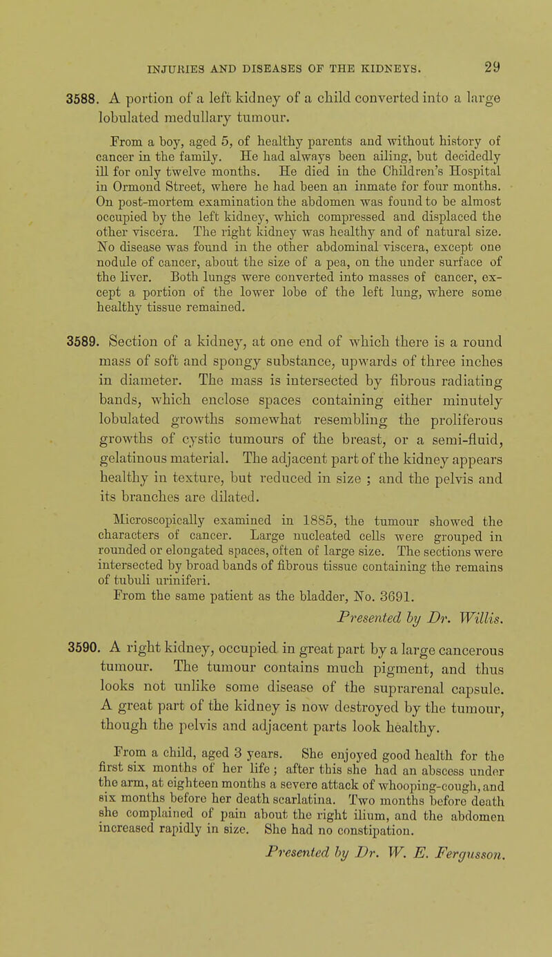3588. A portion of a left kidney of a child converted into a large lobulated medullary tumour. From a boy, aged 5, of healthy parents and without history of cancer in the family. He had always been ailing, but decidedly ill for only twelve months. He died in the Children's Hospital in Ormond Street, where he had been an inmate for four months. On post-mortem examination the abdomen was found to be almost occupied by the left kidney, which compressed and displaced the other viscera. The right kidney was healthy and of natural size. No disease was found in the other abdominal viscera, except one nodide of cancer, about the size of a pea, on the under surface of the liver. Both lungs were converted into masses of cancer, ex- cept a portion of the lower lobe of the left lung, where some healthy tissue remained. 3589. Section of a kidney, at one end of which there is a round mass of soft and spongy substance, upwards of three inches in diameter. The mass is intersected by fibrous radiating bands, which enclose spaces containing either minutely lobulated growths somewhat resembling the proliferous growths of cystic tumours of the breast, or a semi-fluid, gelatinous material. The adjacent part of the kidney appears healthy in texture, but reduced in size ; and the pelvis and its branches are dilated. Microscopically examined in 1885, the tumour showed the characters of cancer. Large nucleated cells were grouped in rounded or elongated spaces, often of large size. The sections were intersected by broad bands of fibrous tissue containing the remains of tubidi uriniferi. From the same patient as the bladder, No. 3691. Presented by Dr. Willis. 3590. A right kidney, occupied in great part by a large cancerous tumour. The tumour contains much pigment, and thus looks not unlike some disease of the suprarenal capsule. A great part of the kidney is now destroyed by the tumour, though the pelvis and adjacent parts look healthy. From a child, aged 3 years. She enjoyed good health for the first six months of her life ; after this she had an abscess under the arm, at eighteen months a severe attack of whooping-cough, and six months before her death scarlatina. Two months before death she complained of pain about the right iHum, and the abdomen increased rapidly in size. She had no constipation. Presented by Dr. W. E. Fergusson.