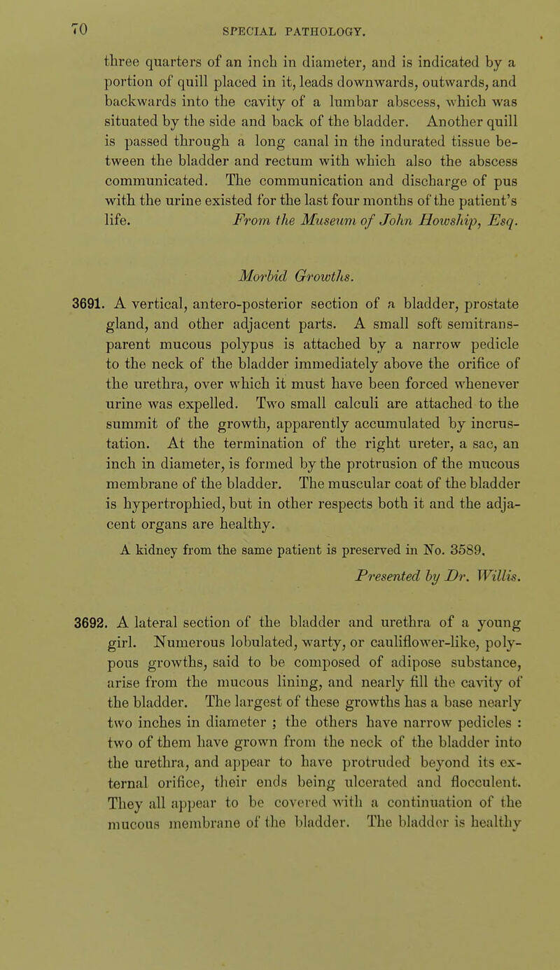 three quarters of an inch in diameter, and is indicated by a portion of quill placed in it, leads downwards, outwards, and backwards into the cavity of a lumbar abscess, which was situated by the side and back of the bladder. Another quill is passed through a long canal in the indurated tissue be- tween the bladder and rectum with which also the abscess communicated. The communication and discharge of pus with the urine existed for the last four months of the patient's life. From the Museum of John Hoivship, Esq. Morbid Growths. 3691. A vertical, antero-posterior section of a bladder, prostate gland, and other adjacent parts. A small soft semitrans- parent mucous polypus is attached by a narrow pedicle to the neck of the bladder immediately above the orifice of the urethra, over which it must have been forced whenever urine was expelled. Two small calculi are attached to the summit of the growth, apparently accumulated by incrus- tation. At the termination of the right ureter, a sac, an inch in diameter, is formed by the protrusion of the raucous membrane of the bladder. The muscular coat of the bladder is hypertrophied, but in other respects both it and the adja- cent organs are healthy. A kidney from the same patient is presei'ved in No. 3589, Presented by Dr. Willis. 3692. A lateral section of the bladder and urethra of a young girl. Numerous lobulated, warty, or cauliflower-like, poly- pous growths, said to be composed of adipose substance, arise from the mucous lining, and nearly fill the cavity of the bladder. The largest of these growths has a base nearly two inches in diameter ; the others have narrow pedicles : two of them have grown from the neck of the bladder into the urethra, and appear to have protruded beyond its ex- ternal orifice, their ends being ulcerated and flocculent. They all appear to be covered with a continuation of the mucous membrane of the bladder. The bladder is healthy
