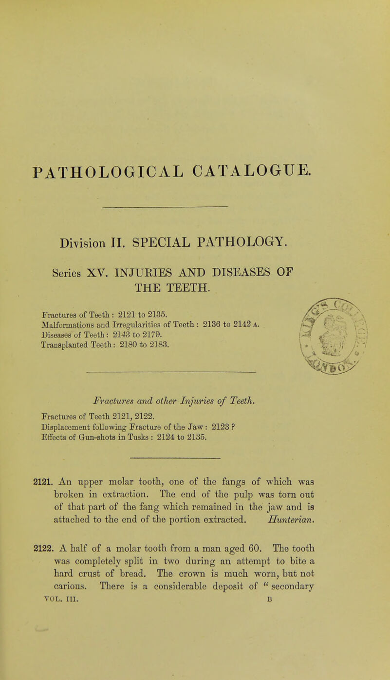 PATHOLOGICAL CATALOGUE. DiYision 11. SPECIAL PATHOLOGY. Series XV. INJURIES AND DISEASES OF THE TEETH. Fractures of Teeth : 2121 to 2135. MaLformations and In-egularities of Teeth : 2136 to 2142 a. Diseases of Teeth : 2143 to 2179. Transplanted Teeth: 2180 to 2183. Fractures and other Injuries of Teeth. Fractures of Teeth 2121, 2122. Displacement following Fracture of the Jaw: 2123 ? Effects of Gun-shots in Tusks : 2124 to 2135. 2121. An upper molar tooth, one of the fangs of which was broken in extraction. The end of the pulp was torn out of that part of the fang which remained in the jaw and is attached to the end of the portion extracted. Hunterian. 2122. A half of a molar tooth from a man aged 60. The tooth was completely split in two during an attempt to bite a hard crust of bread. The crown is much worn, but not carious. There is a considerable deposit of  secondary