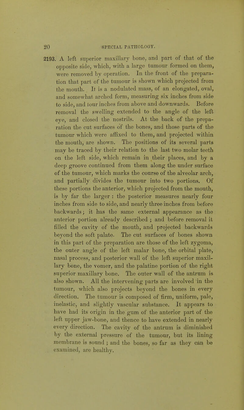 2193. A left superior maxillar}' bone, and part of that of the opposite side, which, with a large tumour formed on them, were removed by operation. In the front of the prepara- tion that part of the tumour is shown which projected from the mouth. It is a nodulated mass, of an elongated, oval, and somewhat arched form, measuring six inches from side to side, and lour inches from above and downwards. Before removal the swelling extended to the angle of the left eye, and closed the nostrils. At the back of the prepa- ration the cut surfaces of the bones, and those parts of the tumour which were affixed to them, and projected within the mouth, are shown. The positions of its several parts may be traced by their relation to the last two molar teeth on the left side, which remain in their places, and by a deep groove continued from them along the under surface of the tumour, which marks the course of the alveolar arch, and partially divides the tumour into two portions. Of these portions the anterior, which projected from the mouth, is by far the larger : the posterior measures nearly four inches from side to side, and nearly three inches from before backwards; it has the same external appearance as the anterior portion already described ; and before removal it filled the cavity of the mouth, and projected backwards beyond the soft palate. The cut surfaces of bones shown in this part of the preparation are those of the left zygoma, the outer angle of the left malar bone, the orbital plate, nasal process, and posterior wall of the left superior maxil- lary bone, the vomer, and the palatine portion of the right superior maxillary bone. The outer wall of the antrum is also shown. All the intervening parts are involved in the tumour, which also projects beyond the bones in every direction. The tumour is composed of firm, uniform, pale, inelastic, and slightly vascular substance. It appears to have had its origin in the gum of the anterior part of the left upper jaw-bone, and thence to have extended in nearly every direction. The cavity of the antrum is diminished by the external pressure of the tumour, but its lining membrane is sound ; and the bones, so far as they can be examined, are healthy.